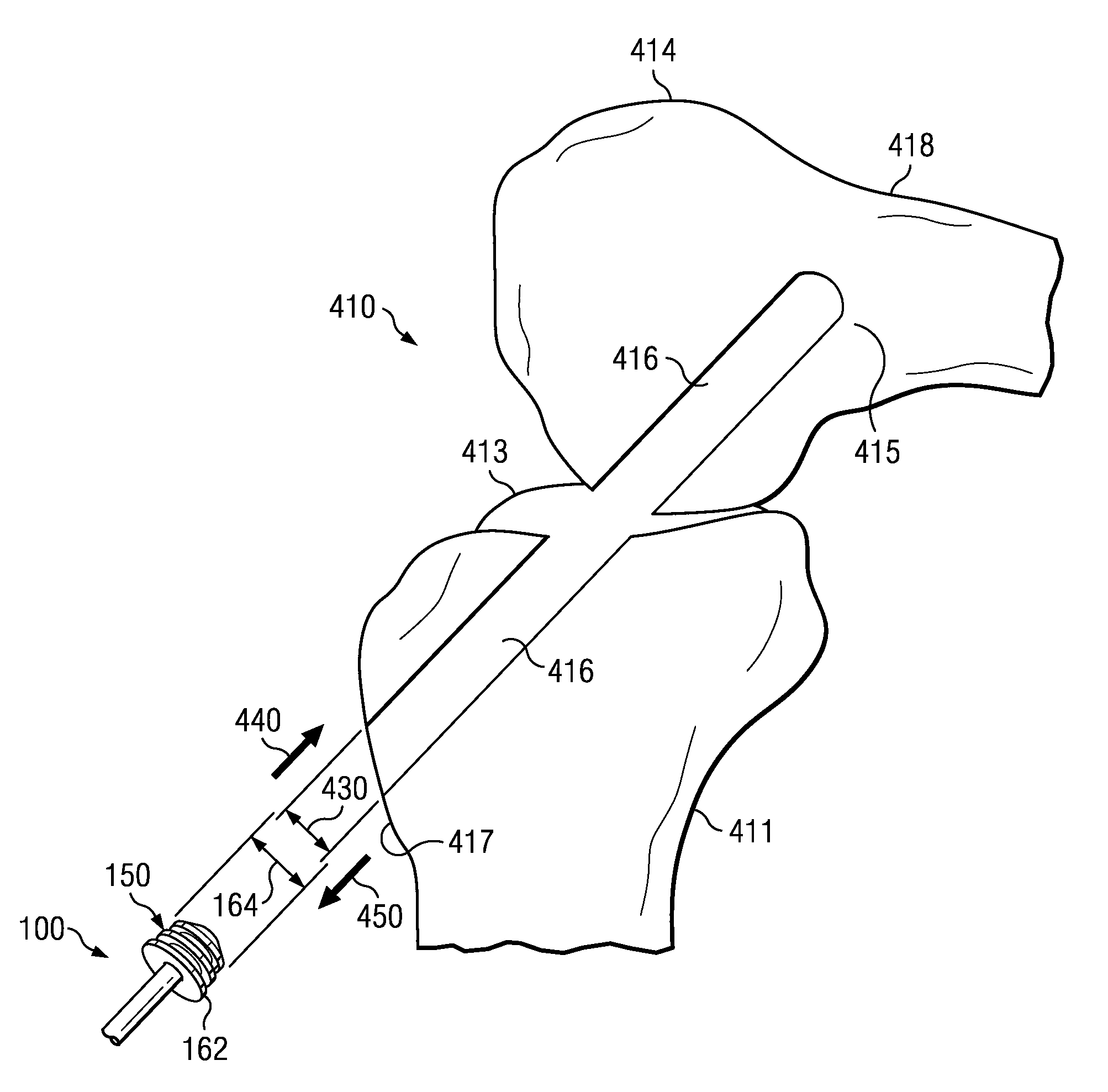 Graft pulley and methods of use