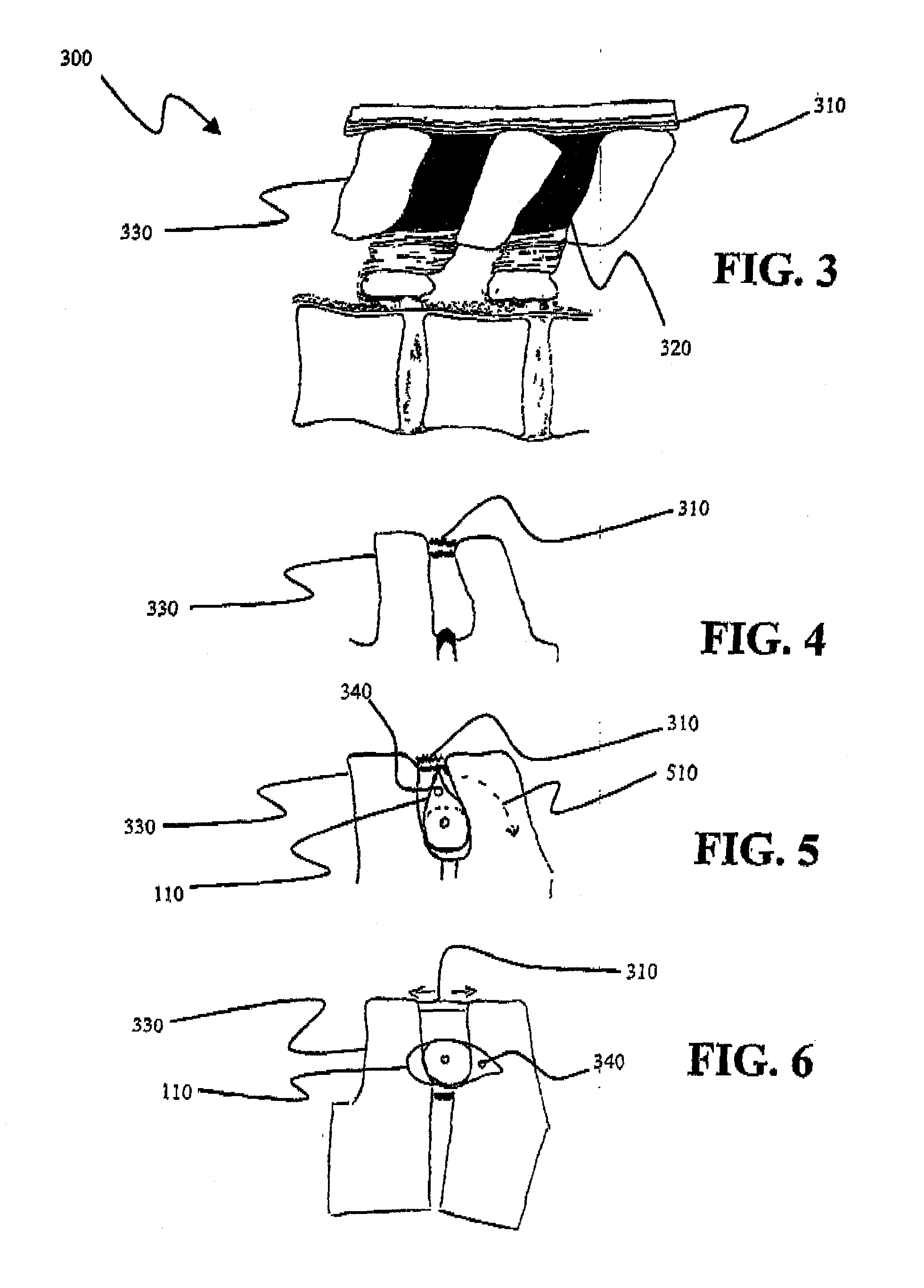 Interspinous Internal Fixation/Distraction Device