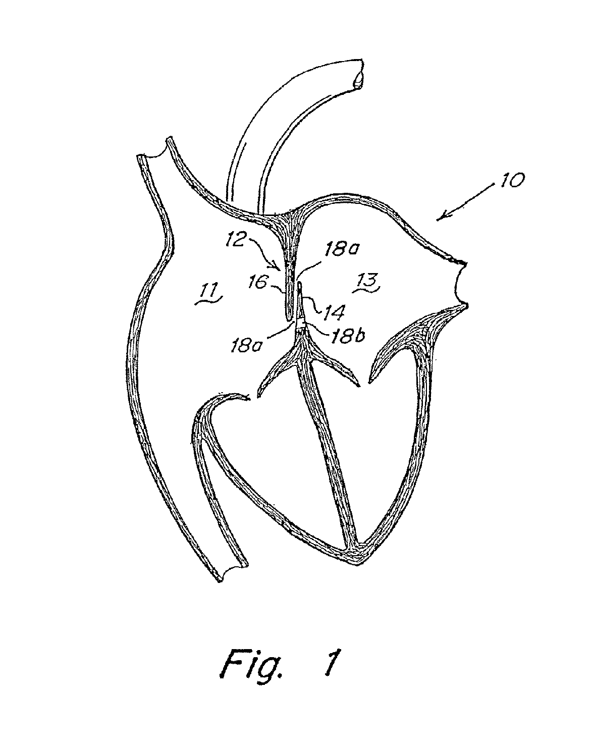 Adjustable length patent foramen ovale (PFO) occluder and catch system