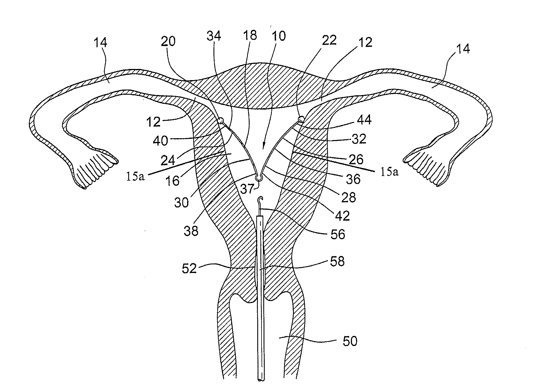 Intrauterine device