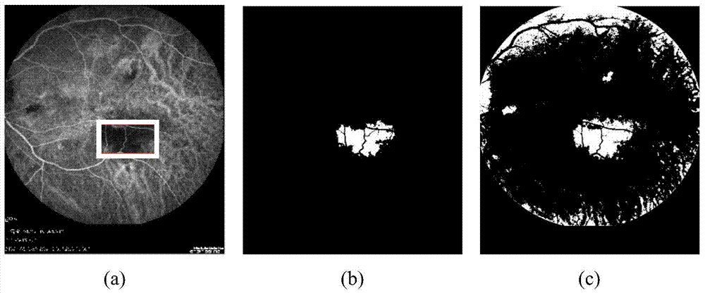 Fluorescein contrast fundus image extraction method based on ngc-acm
