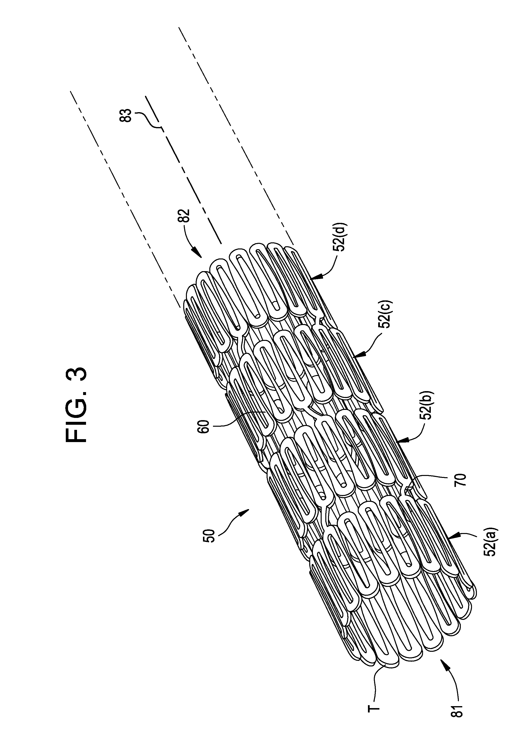 Intravascular stent having imrproved design for loading and deploying