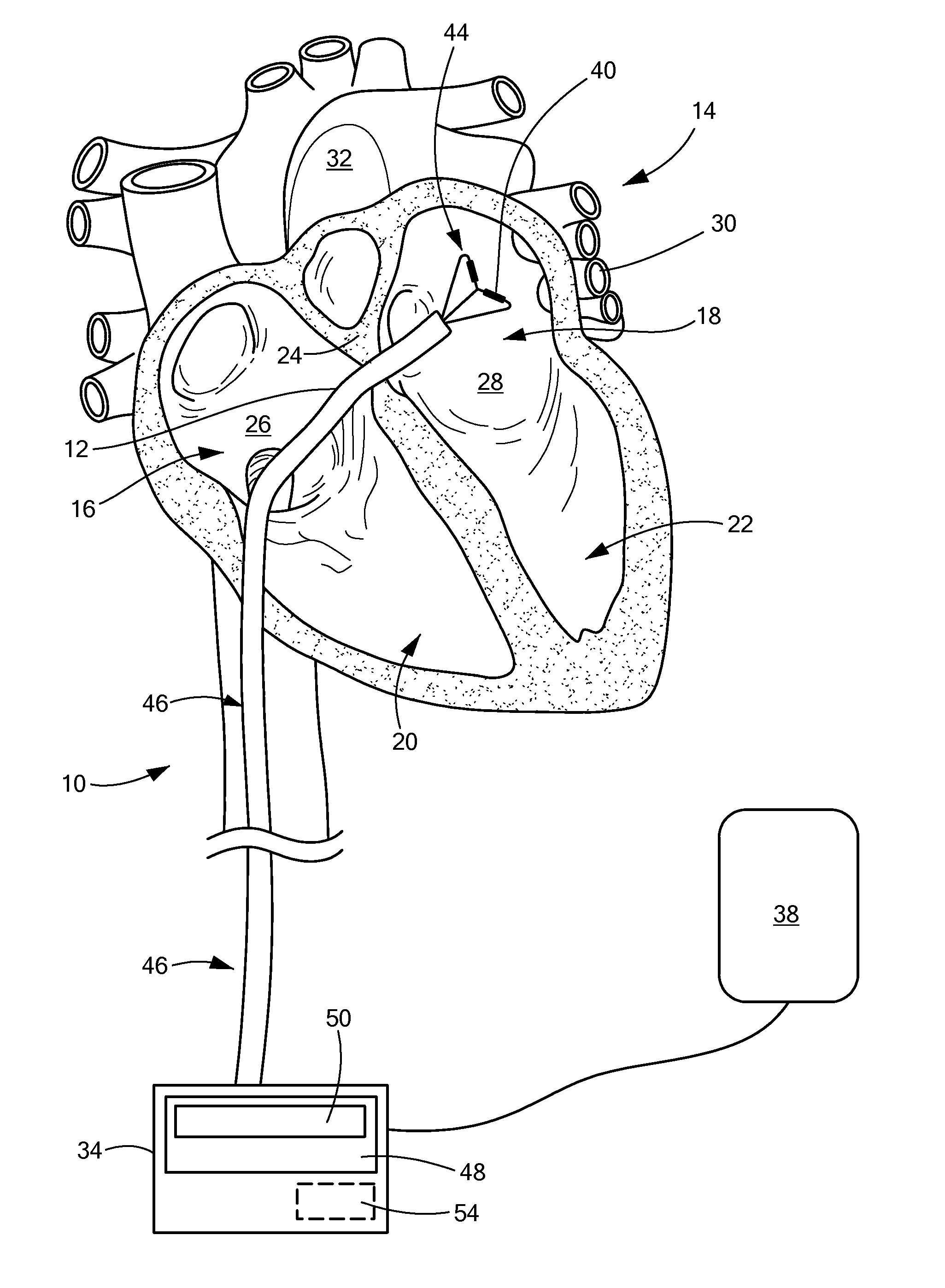 Controlled RF energy in a multi-electrode catheter