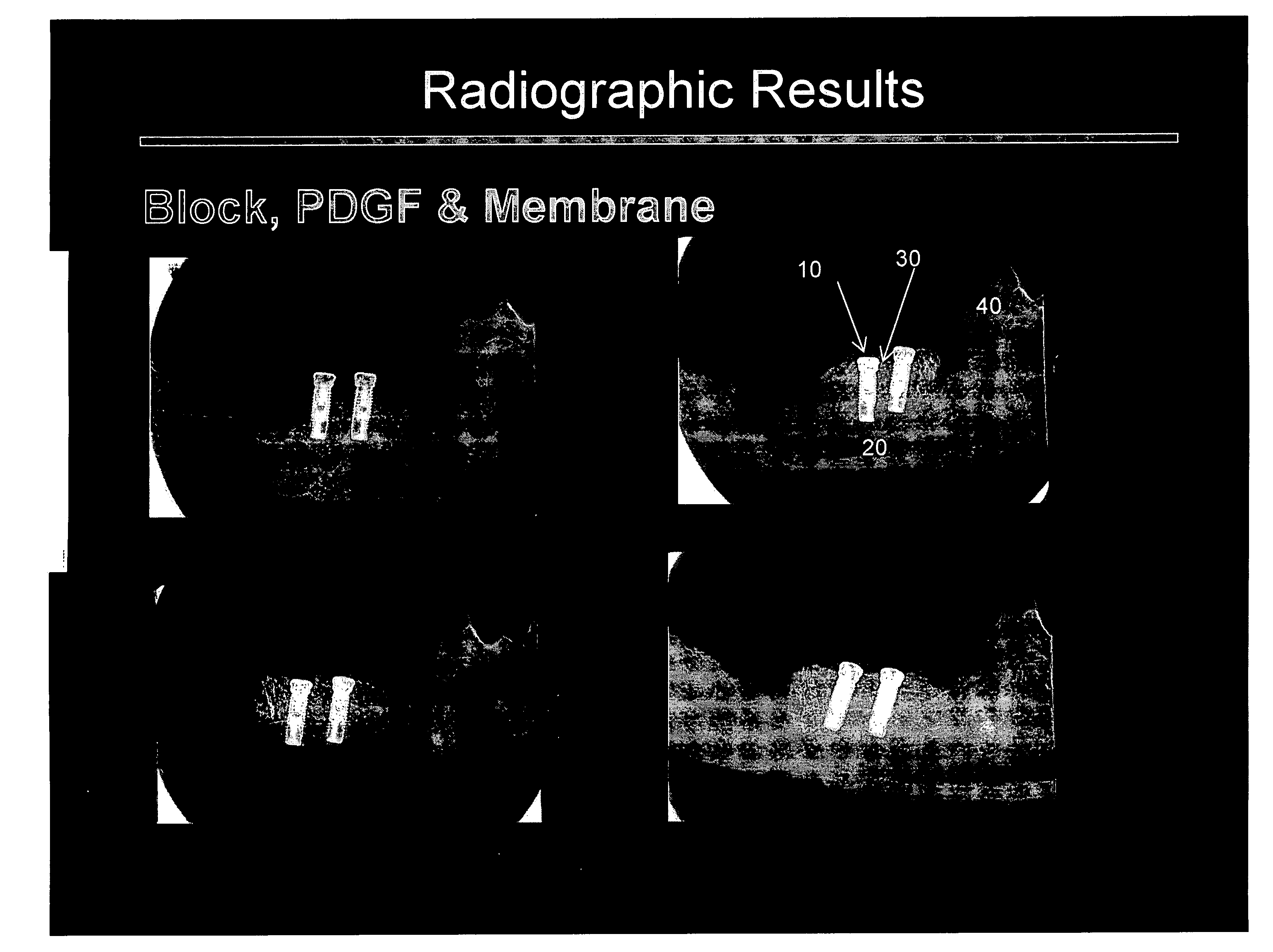 Maxillofacial bone augmentation using rhPDGF-BB and a biocompatible matrix