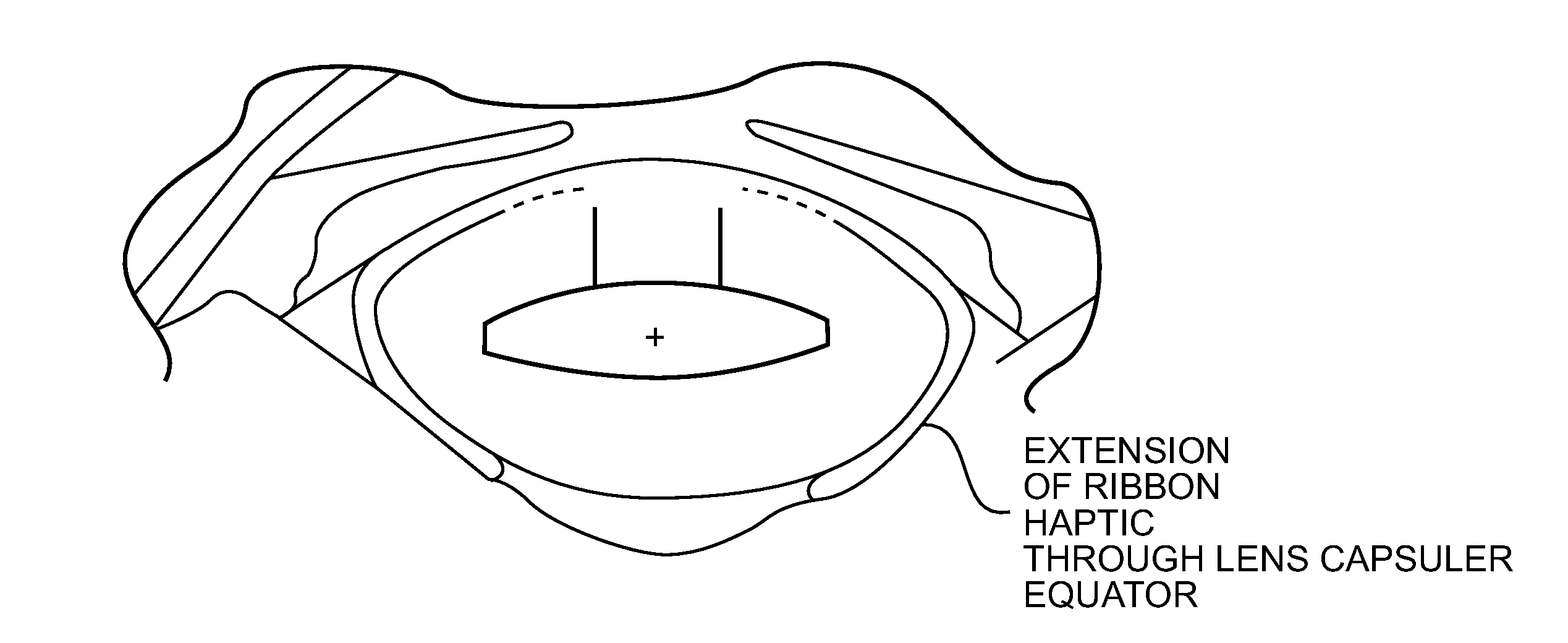 Pseudophakic Accommodating Intraocular Lens
