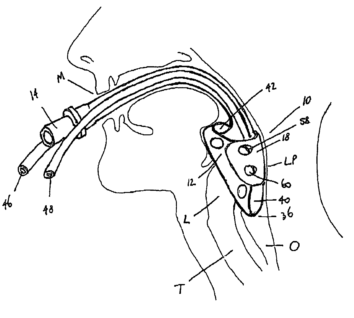 Laryngeal mask