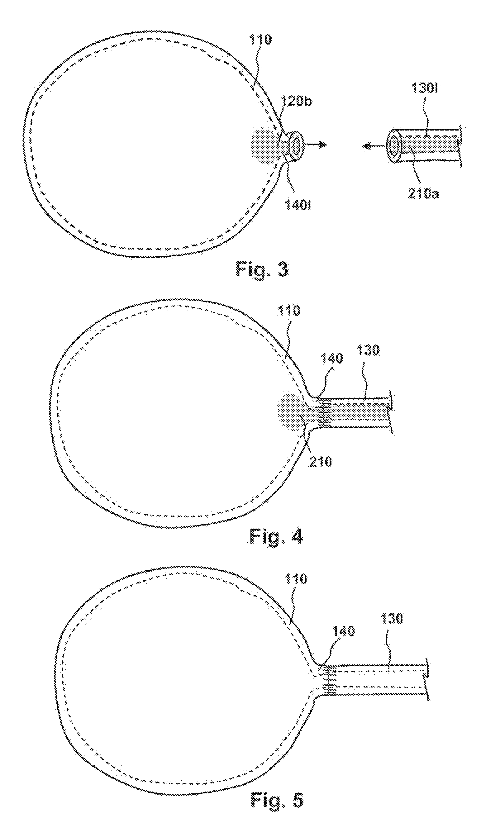 Methods, compositions and kits for performing anastomosis procedures in conjunction with a radical prostatectomy procedure