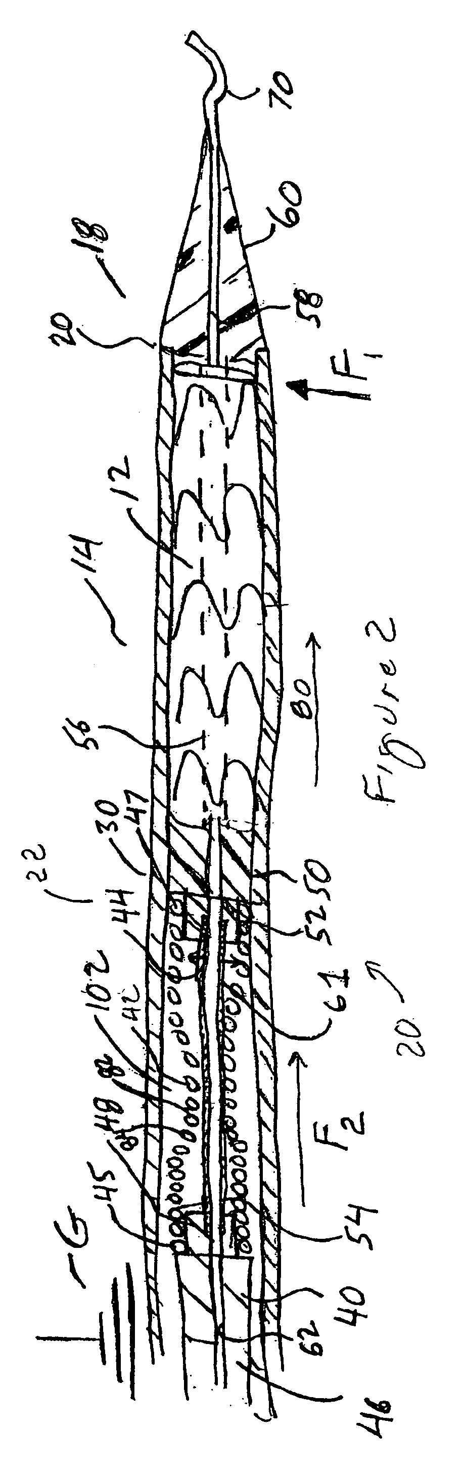 Intravascular deployment device with improved deployment capability
