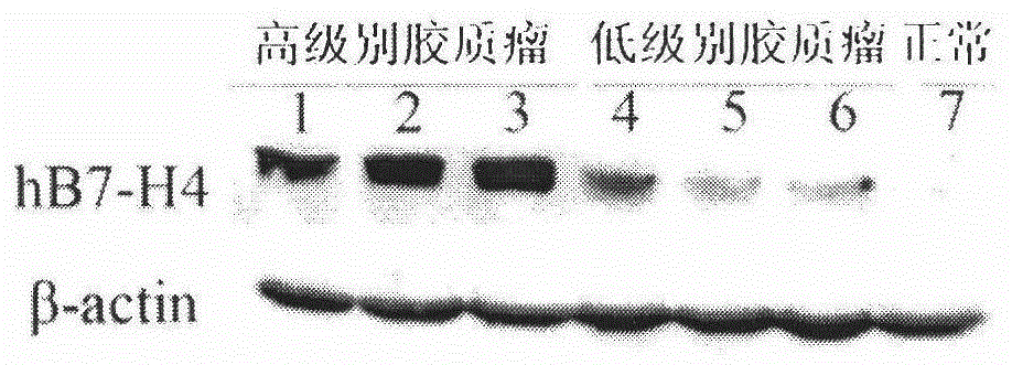 A kit for early diagnosis of glioma