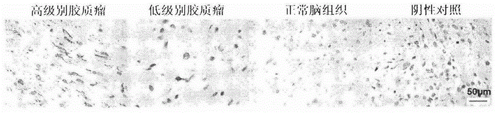 A kit for early diagnosis of glioma