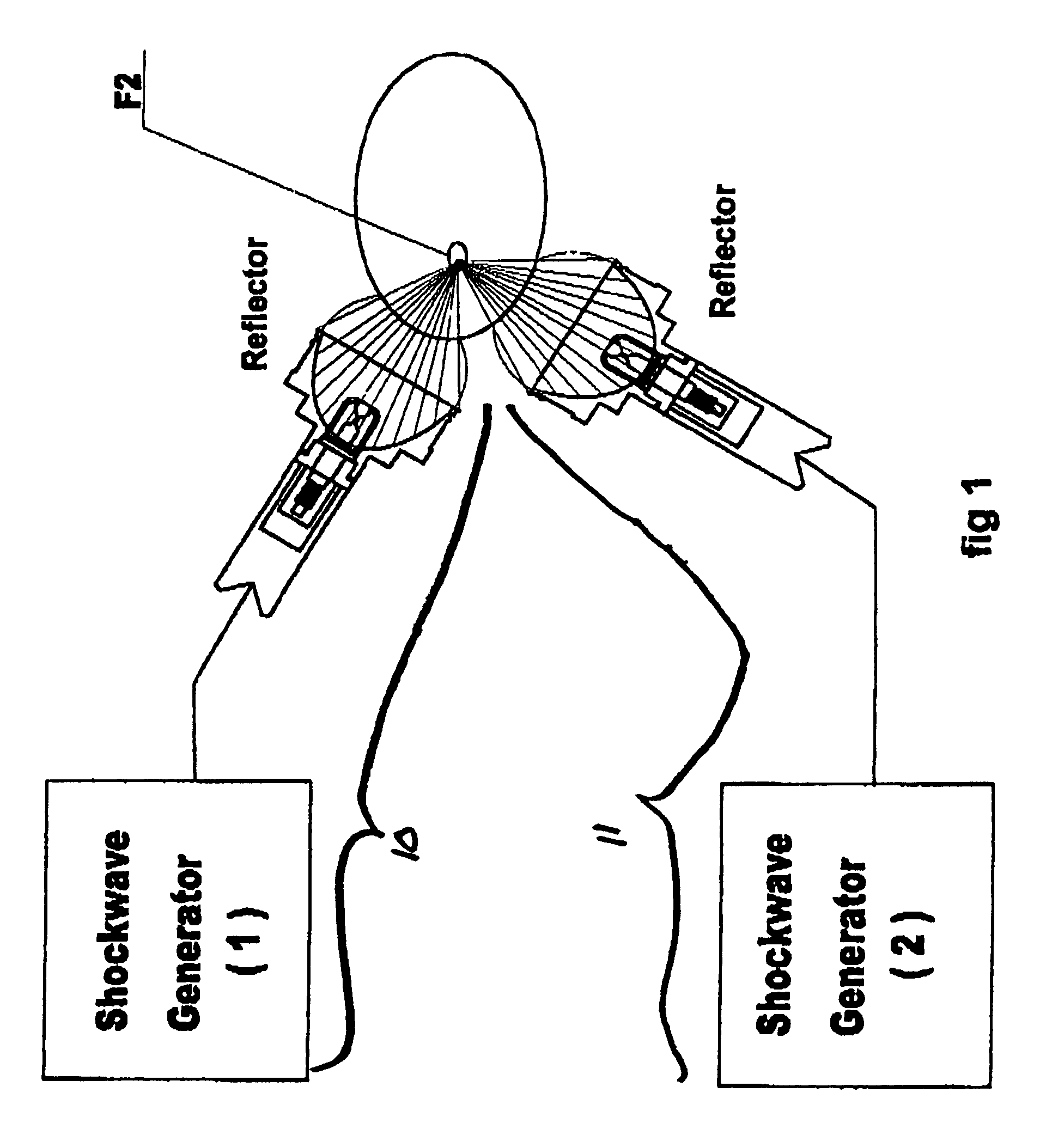 Multiple shockwave focal treatment apparatus with targeting positioning and locating apparatus