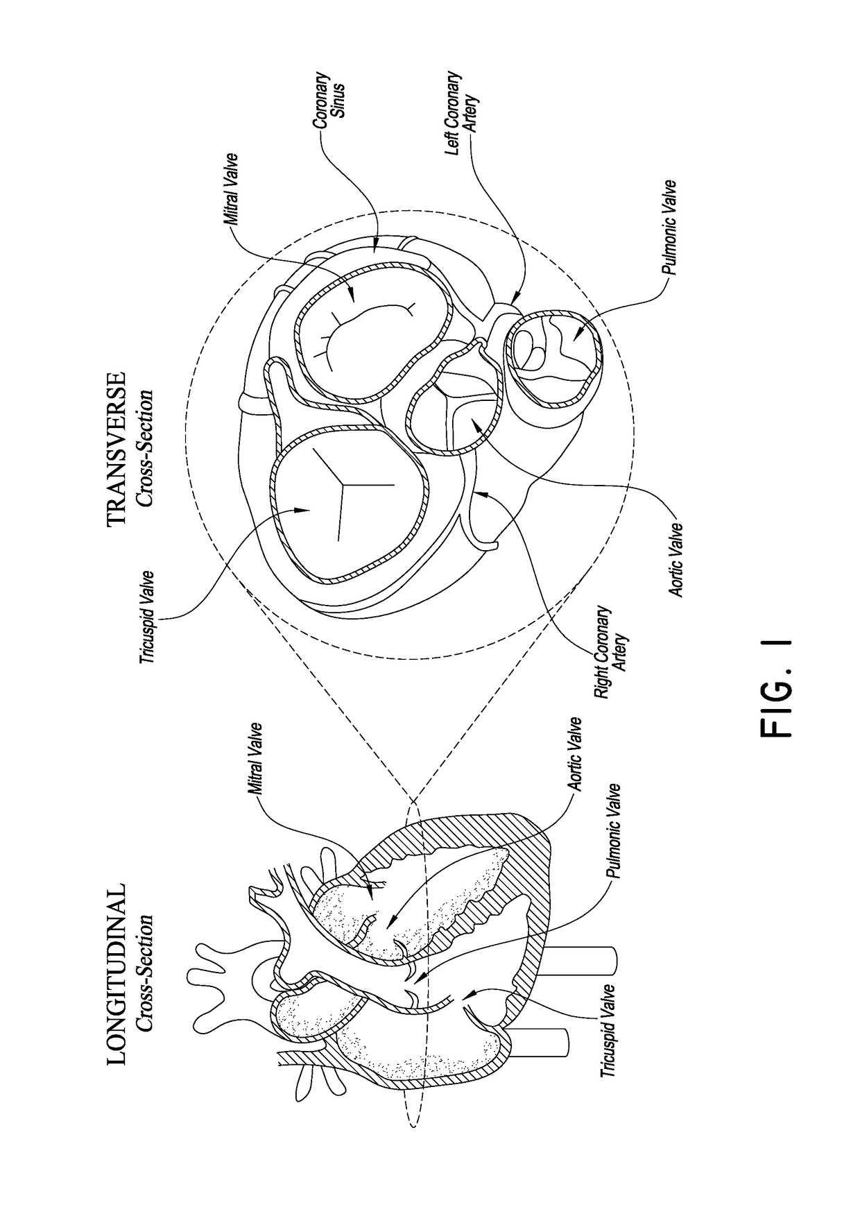 Catheter based apical approach heart prostheses delivery system