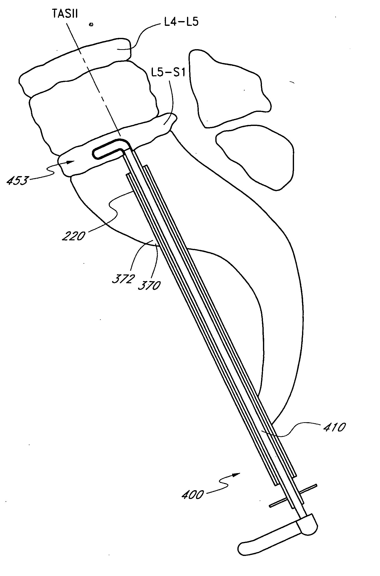 Method and apparatus for manipulating material in the spine