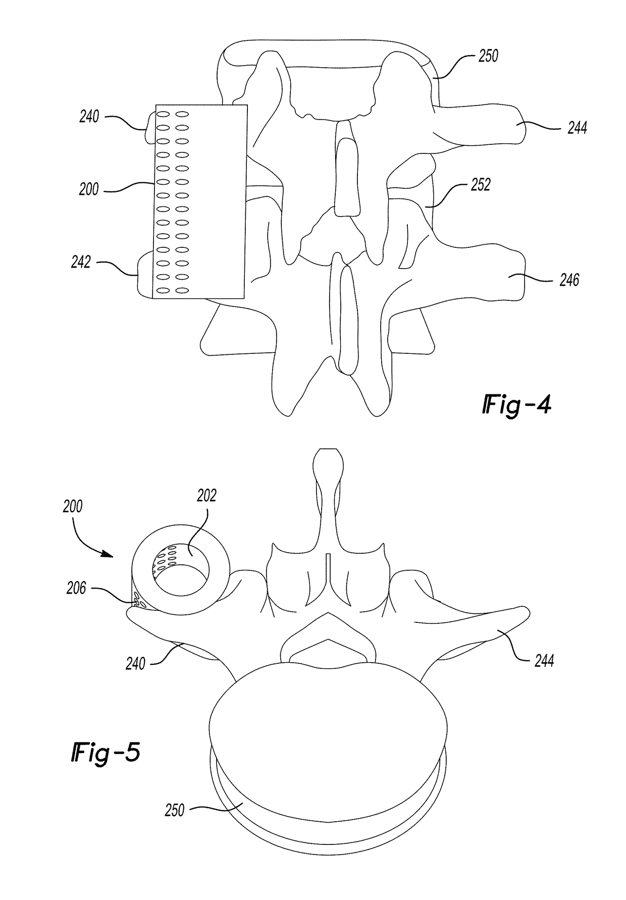 Biodegradable implant for intertransverse process fusion