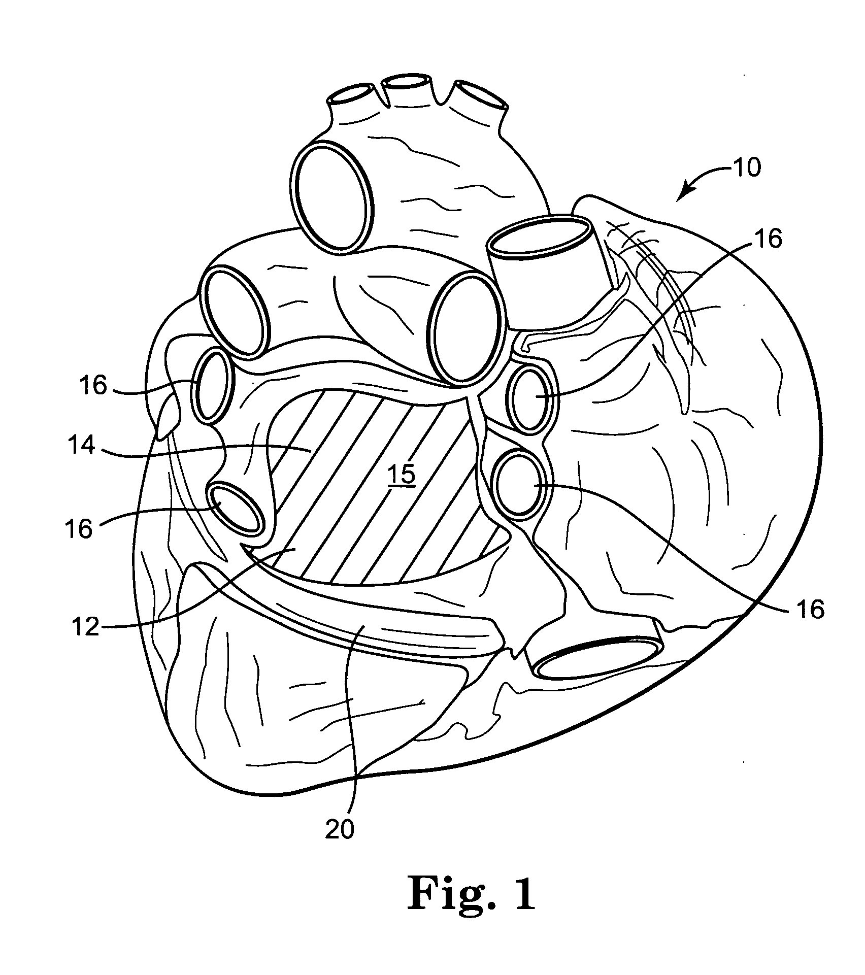 Method and devices for treating atrial fibrillation by mass ablation