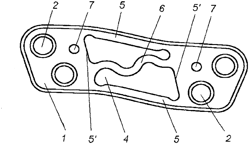 Scapholunate stabilization implant