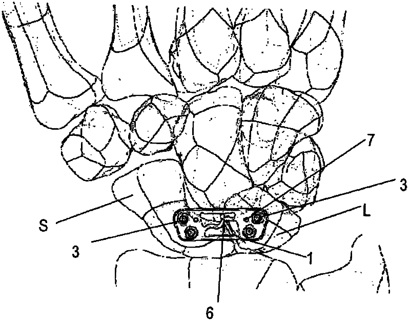 Scapholunate stabilization implant