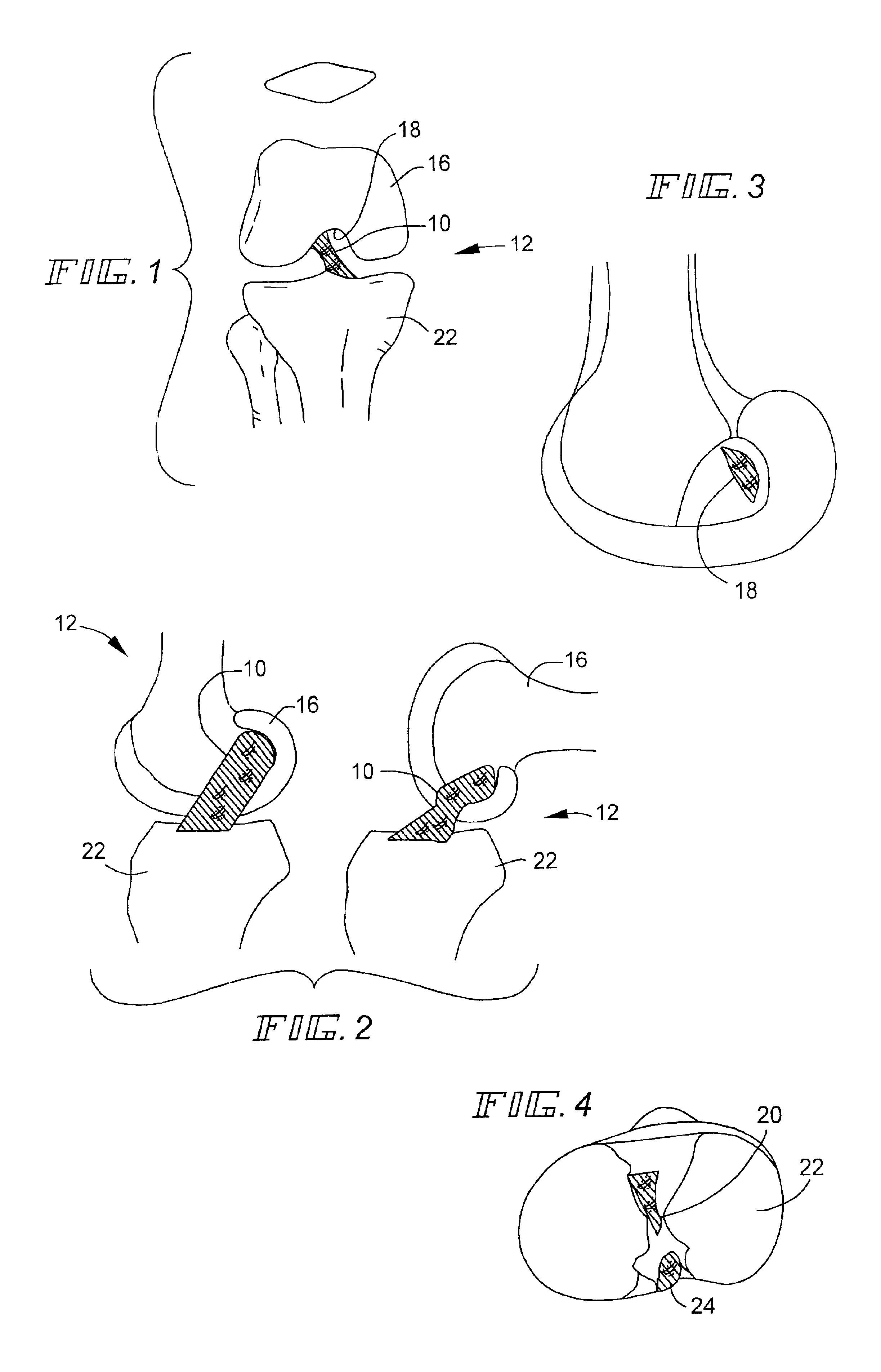 Ligament reconstruction tensioning device