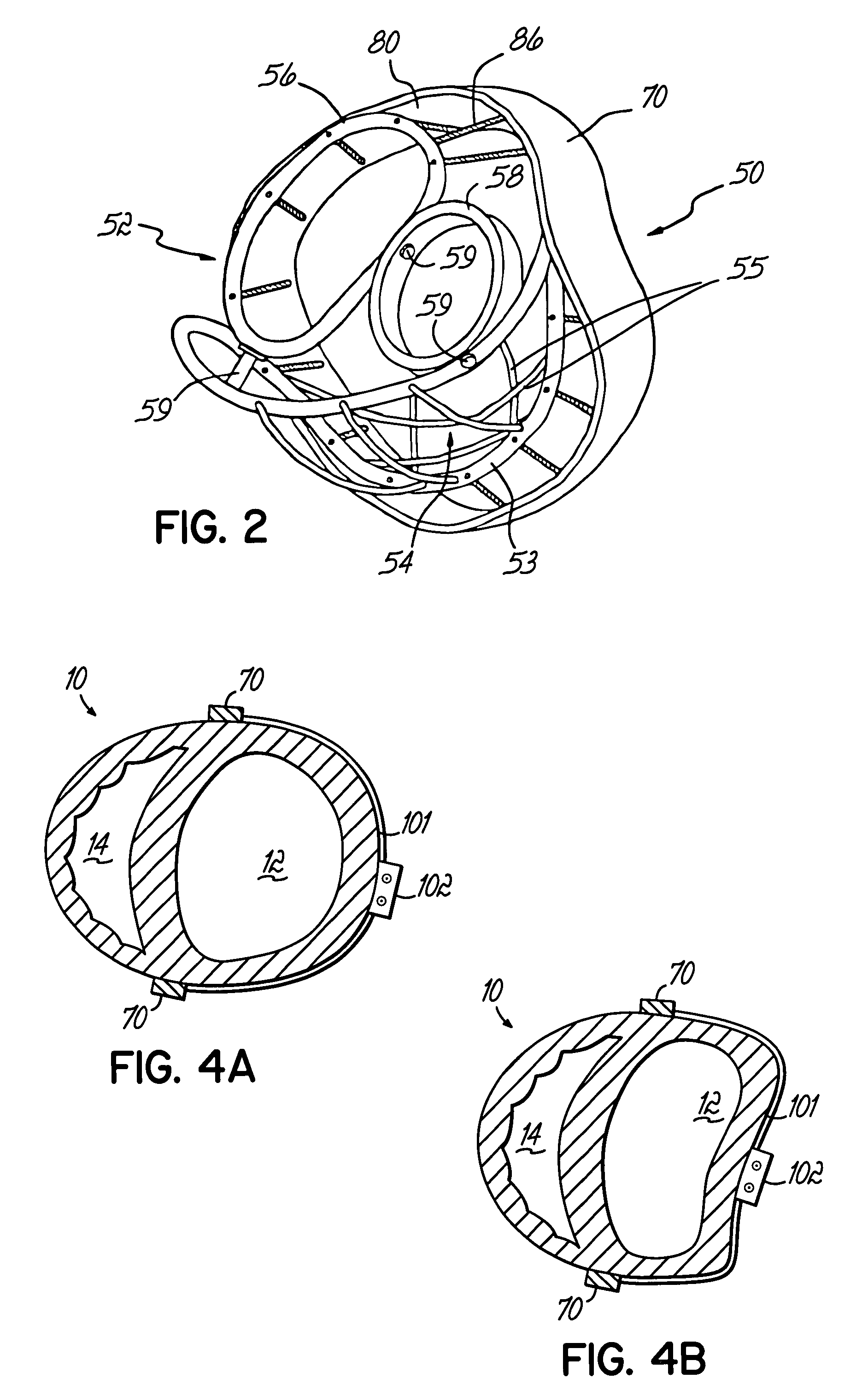 Heart wall actuation device for the natural heart