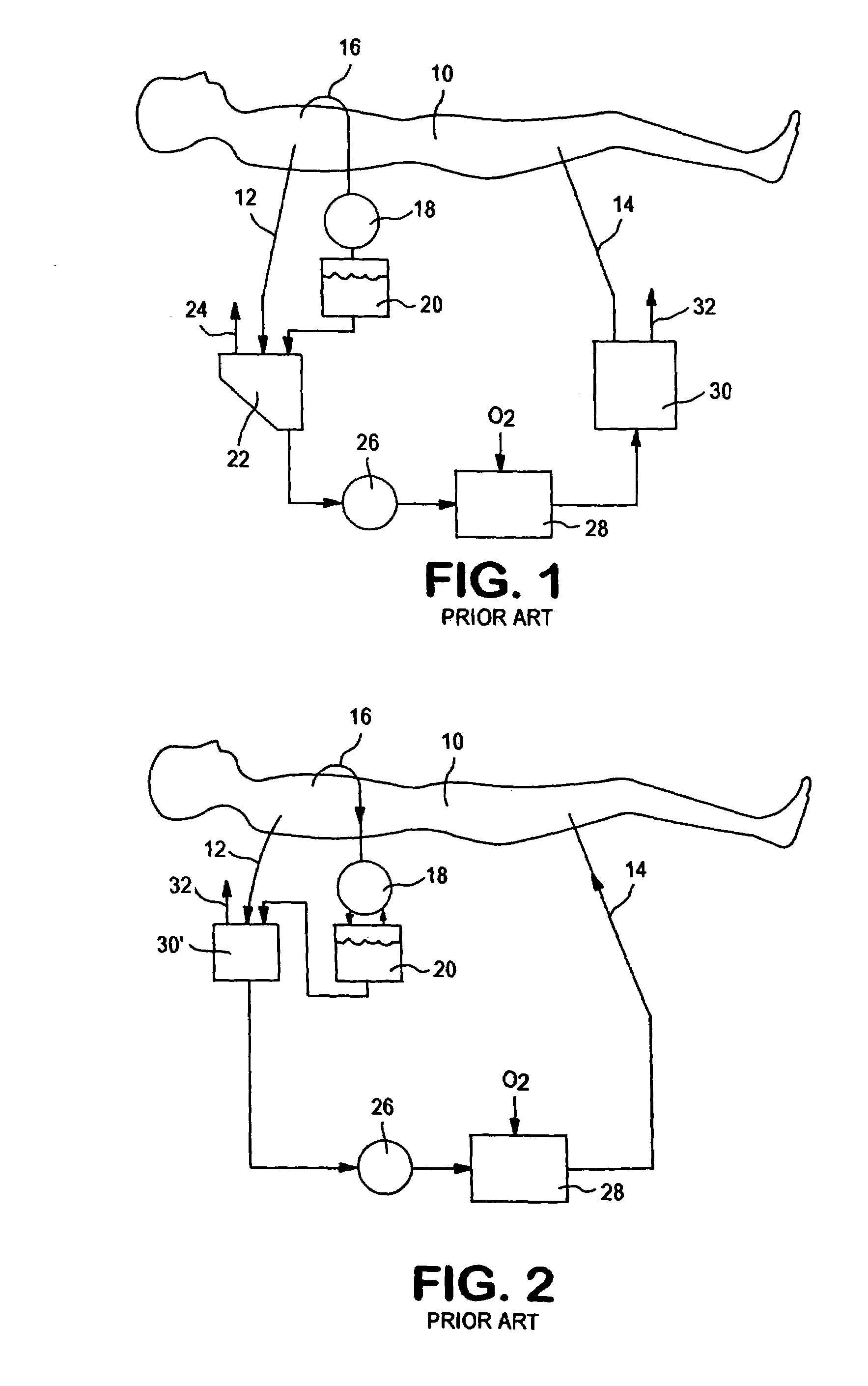 Active air removal system operating modes of an extracorporeal blood circuit