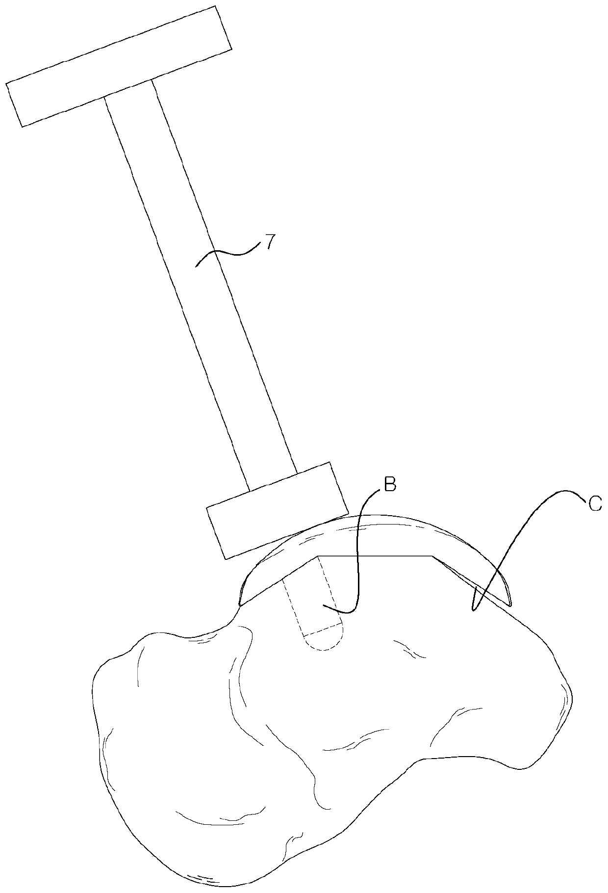 Artificial ankle joint talus component