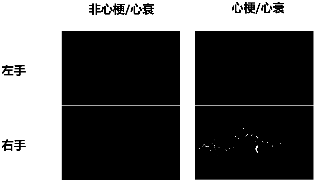 Method for judging myocardial infarction, heart failure and healing degrees on basis of zygomorphy and intensity of nail autofluorescence and application thereof