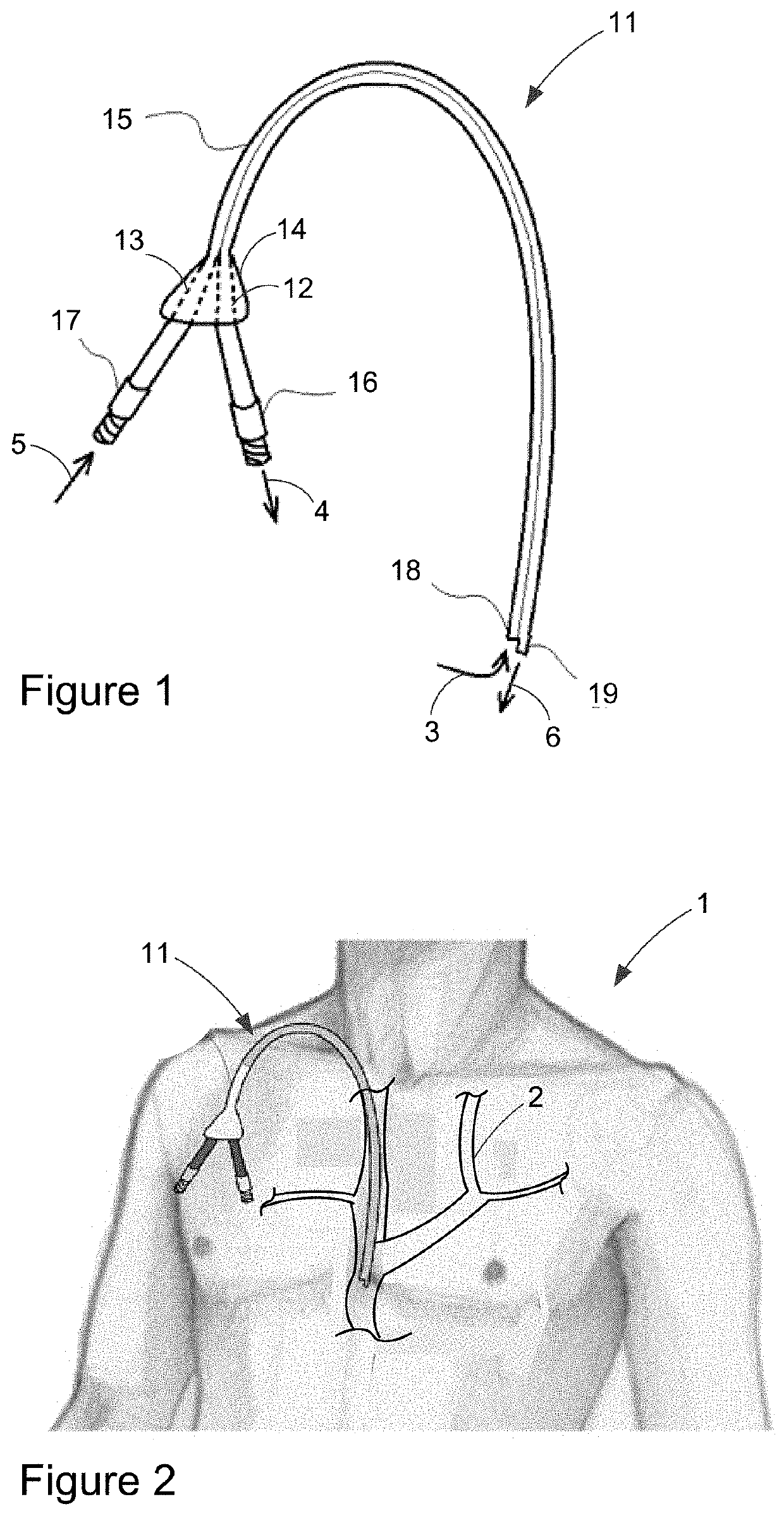 Catheter clearance device and method of use