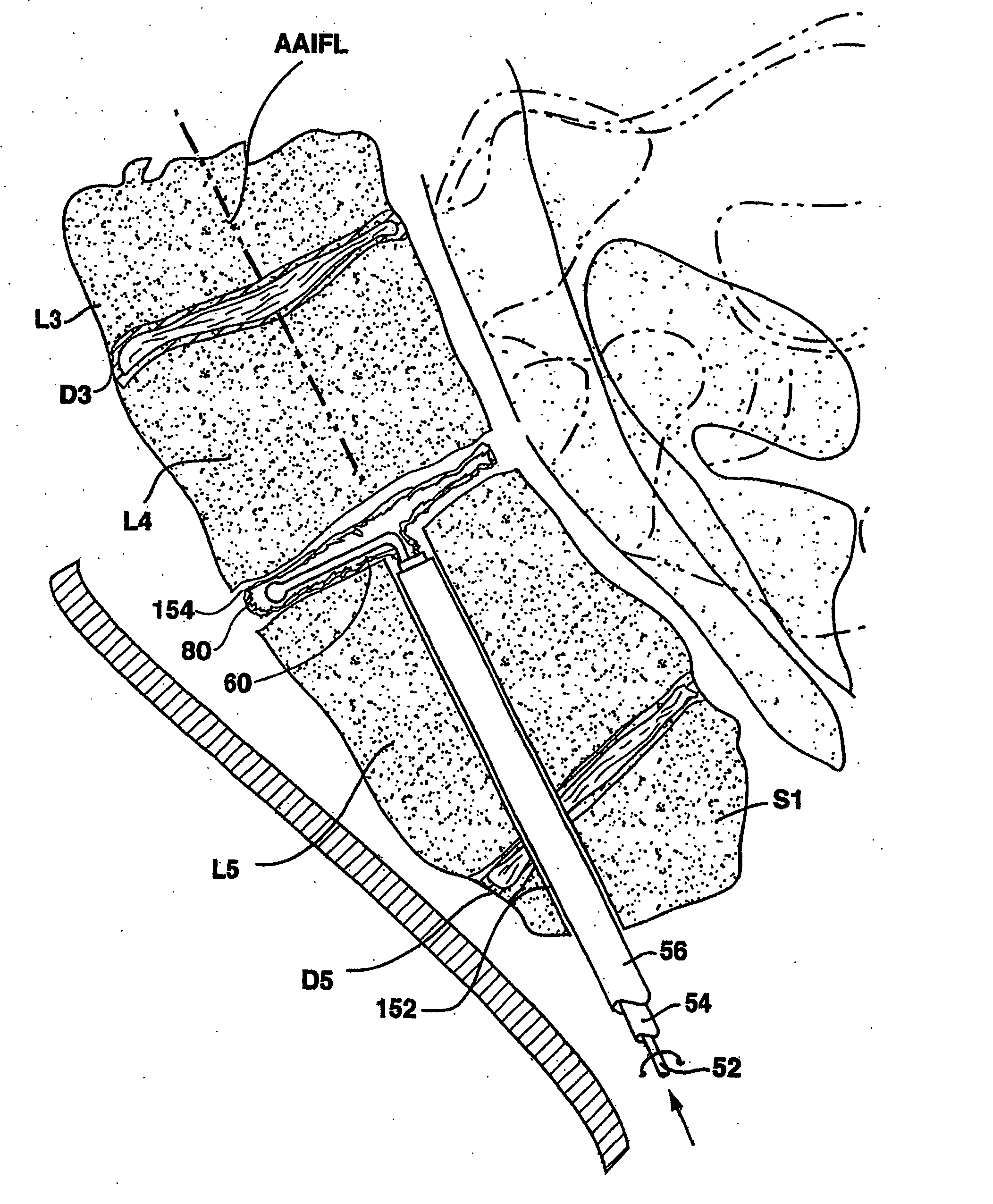 Method and apparatus for spinal distraction and fusion