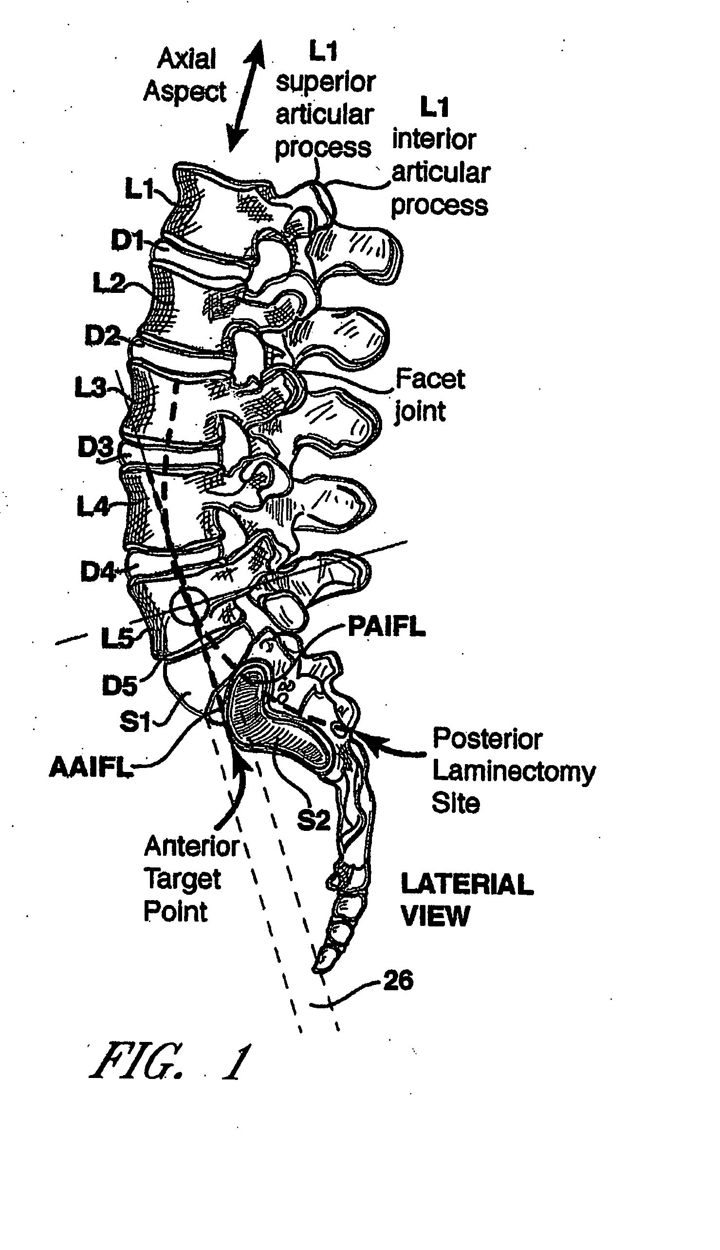 Method and apparatus for spinal distraction and fusion