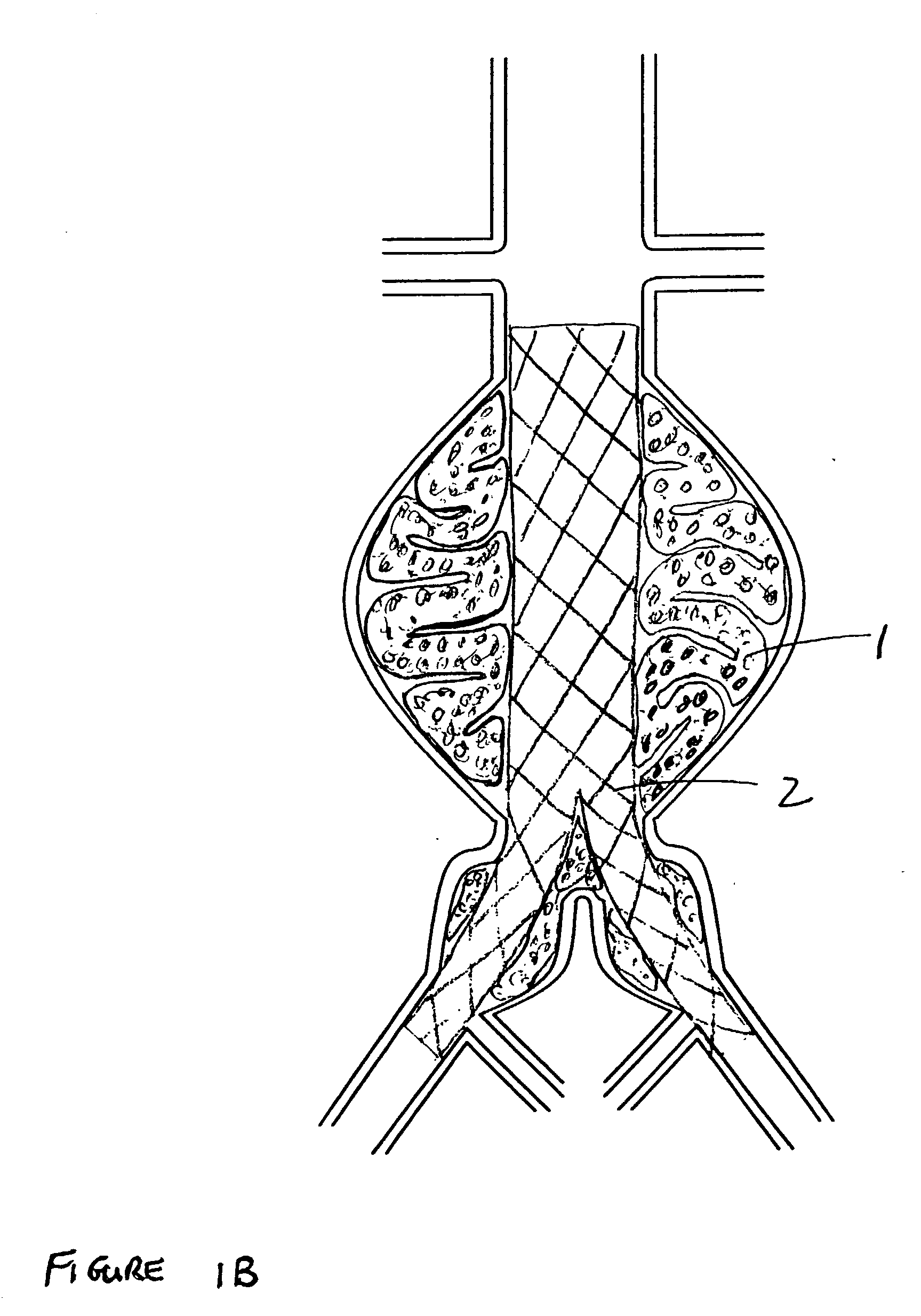 Devices and methods for treatment of vascular aneurysms