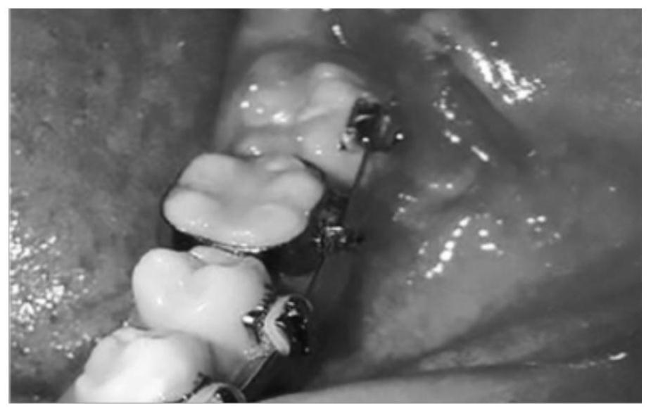 Cantilever spring for impacted molar tooth traction, impacted tooth traction device and impacted tooth traction method