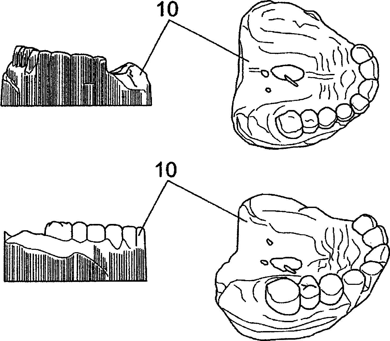 Method for manufacturing digitally-designed removable dental prostheses and system required for this purpose