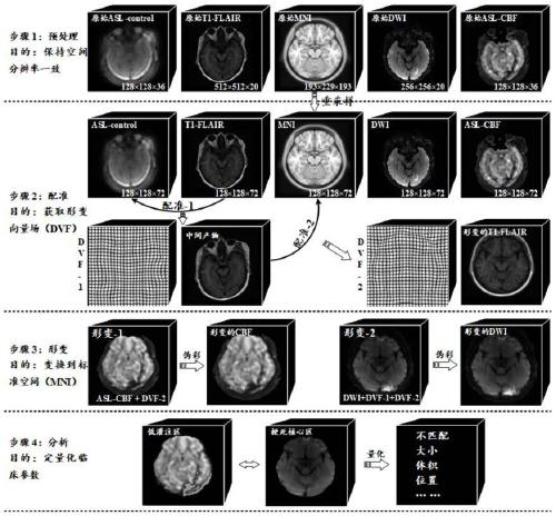 Magnetic resonance perfusion-diffusion image registration method for acute ischemic stroke