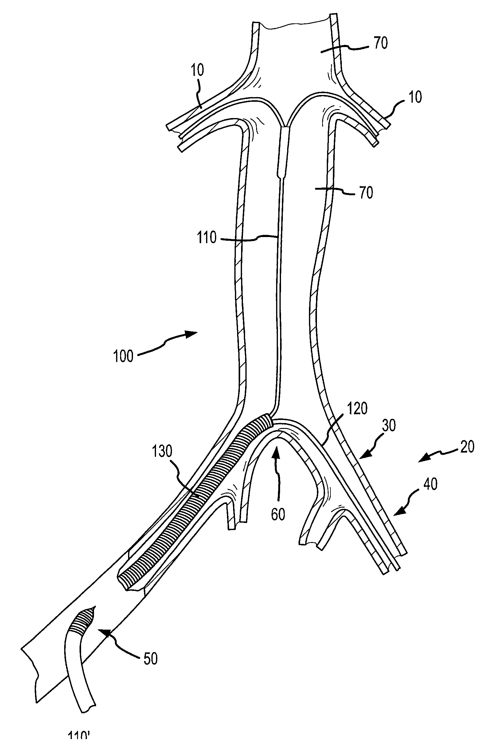 Vascular sheath with variable lumen construction