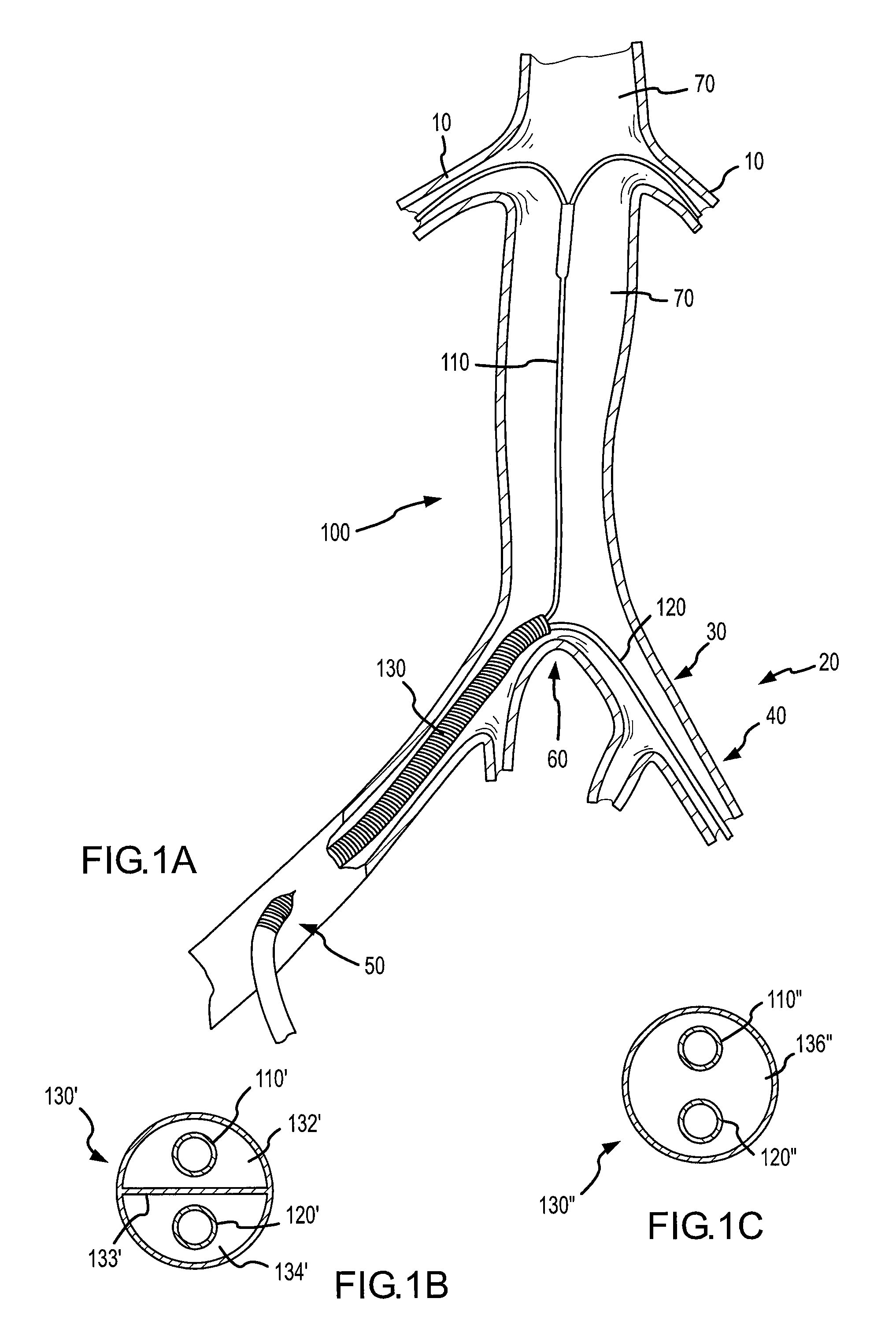 Vascular sheath with variable lumen construction
