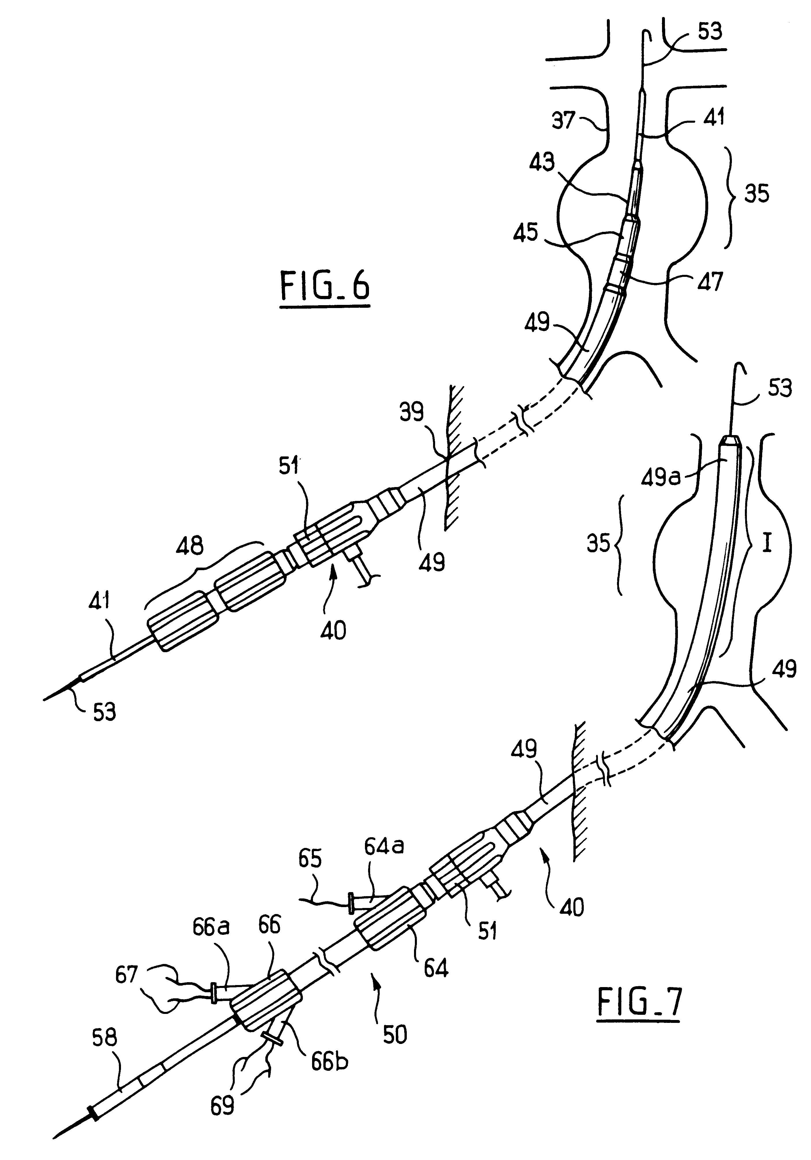 System for repairing an anatomical canal by means of an implant with a progressive opening