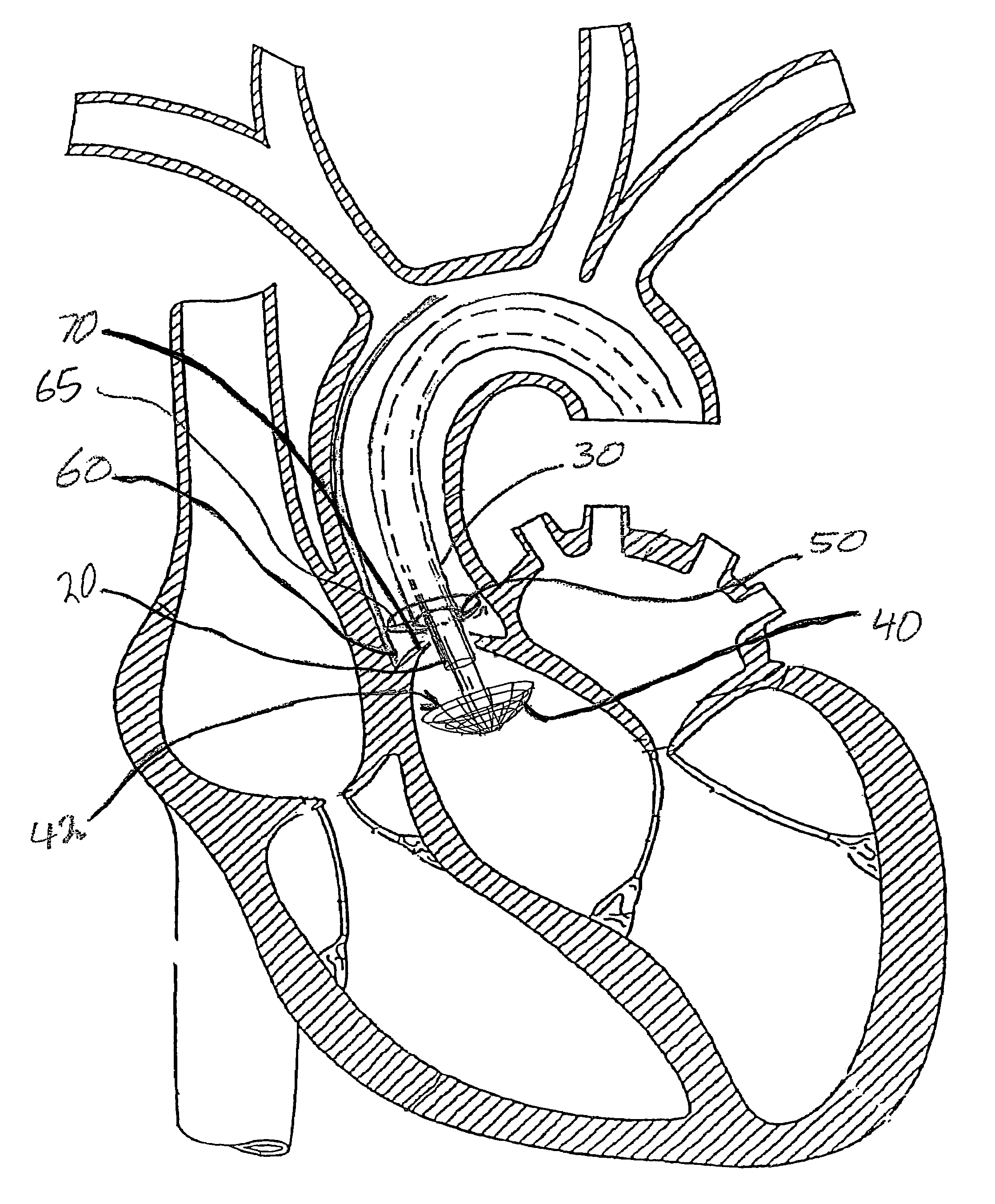 Apparatus and method for cutting a heart valve