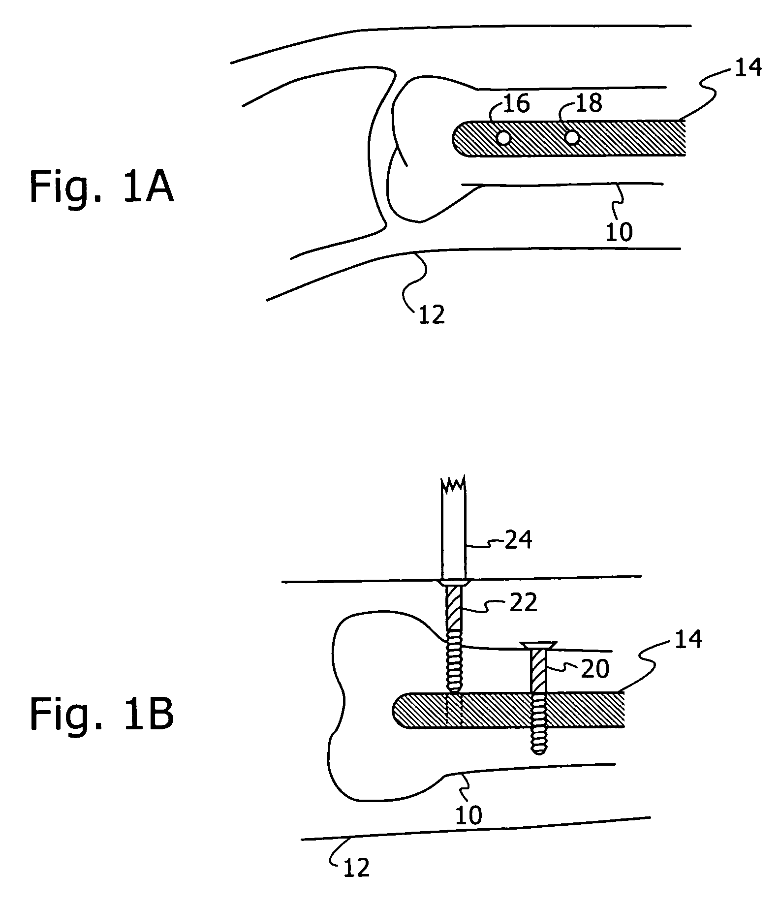 Robotic method for use with orthopedic inserts