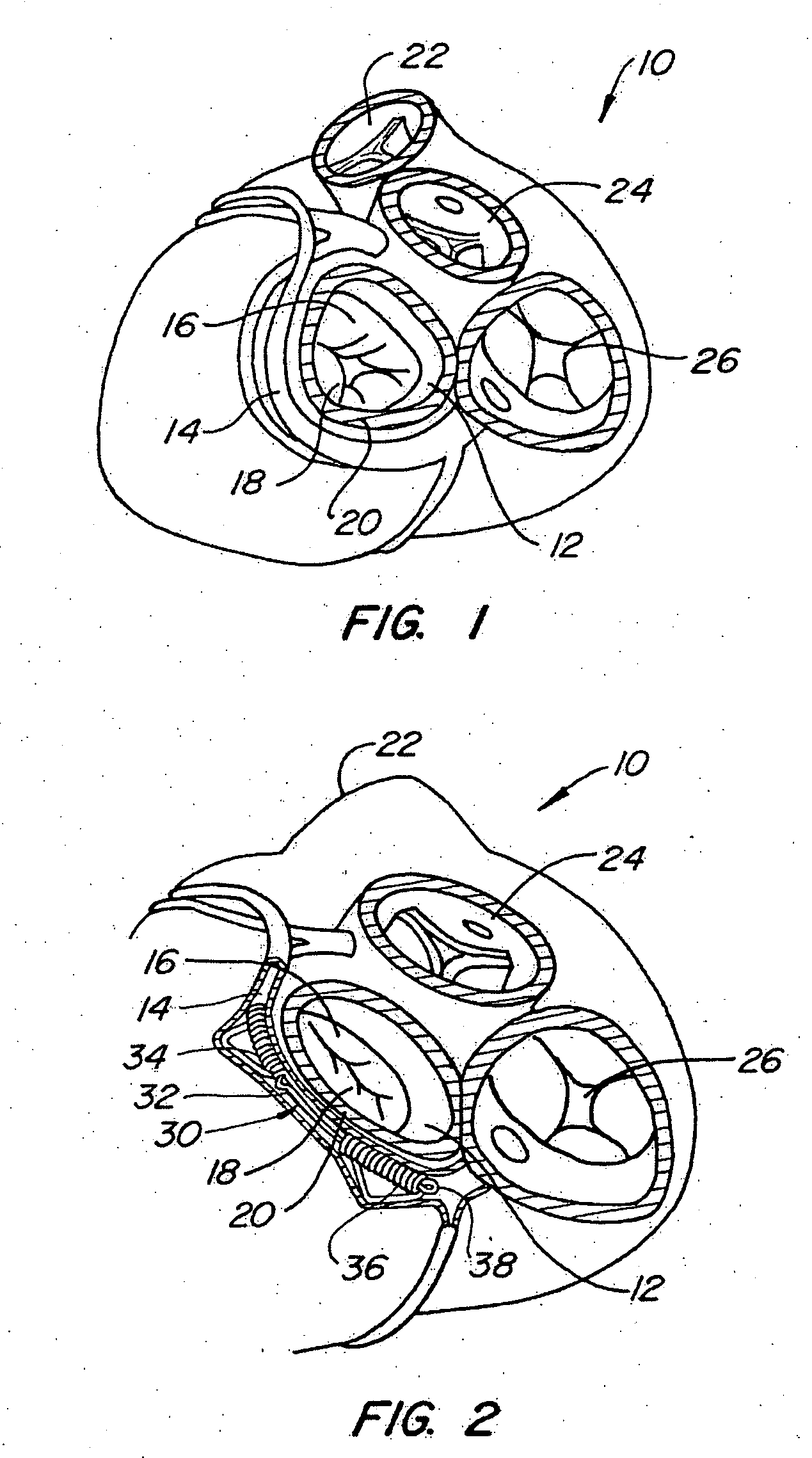 System and method to effect the mitral valve annulus of a heart