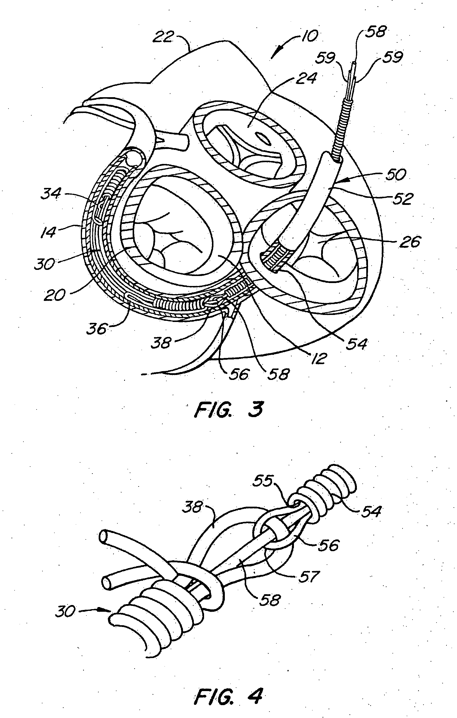 System and method to effect the mitral valve annulus of a heart