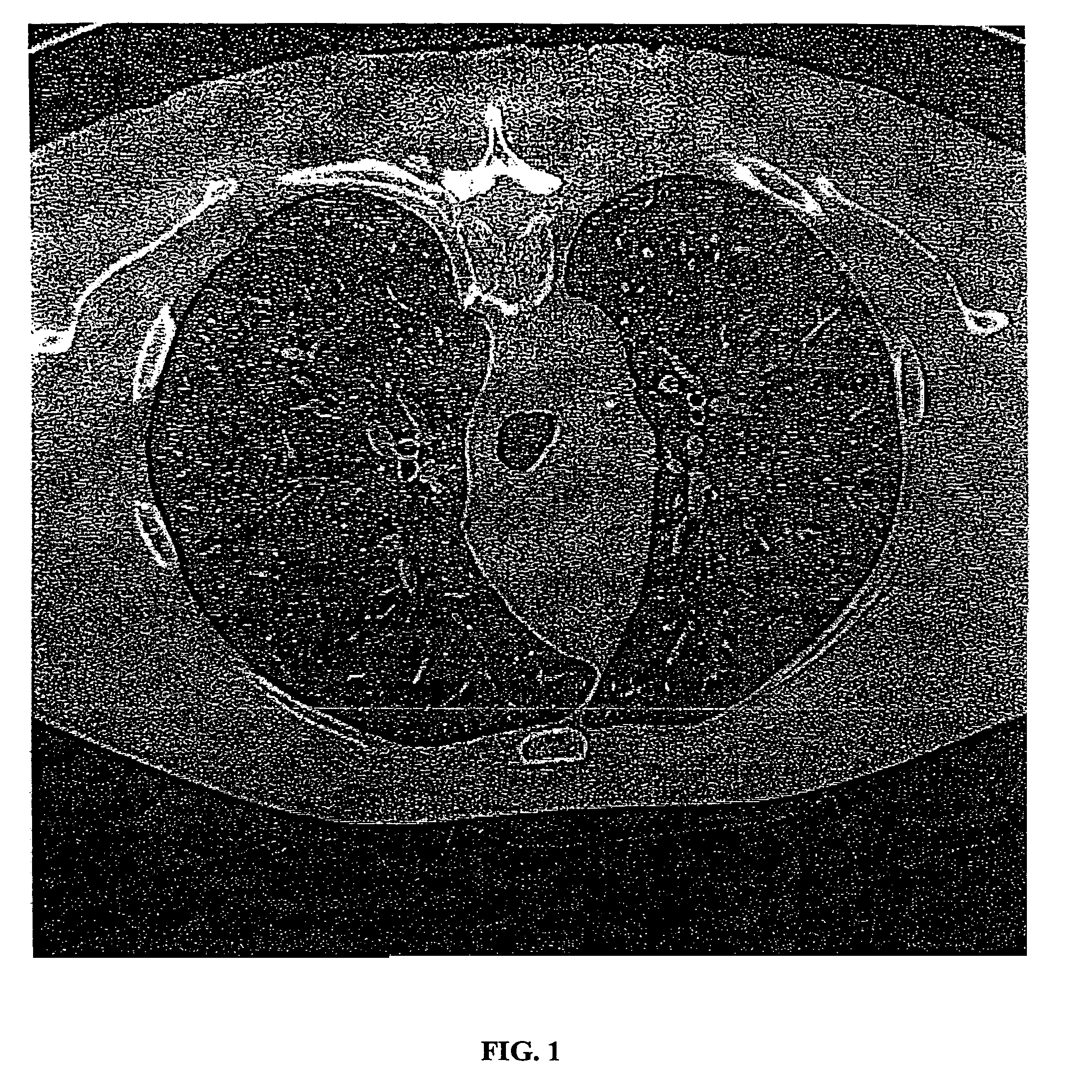 Density nodule detection in 3-D digital images