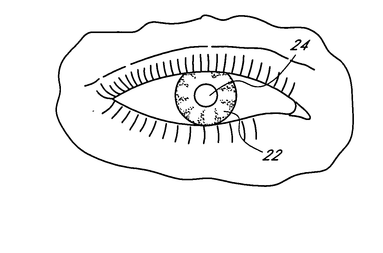 Method of making an ocular implant