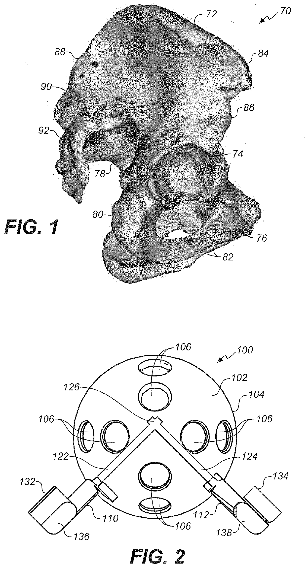 Bone Cutting Guide System for Osteochondral Transplantation