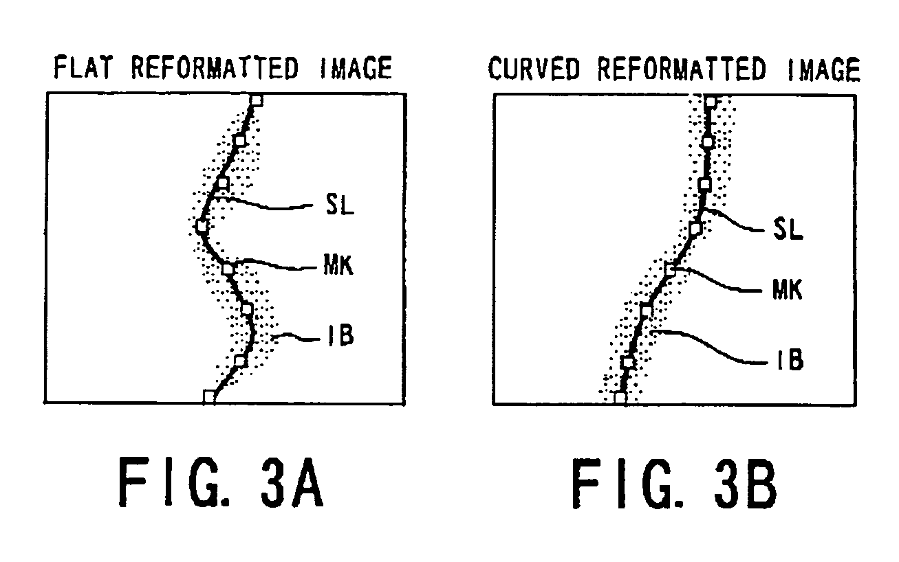 Processor for analyzing tubular structure such as blood vessels