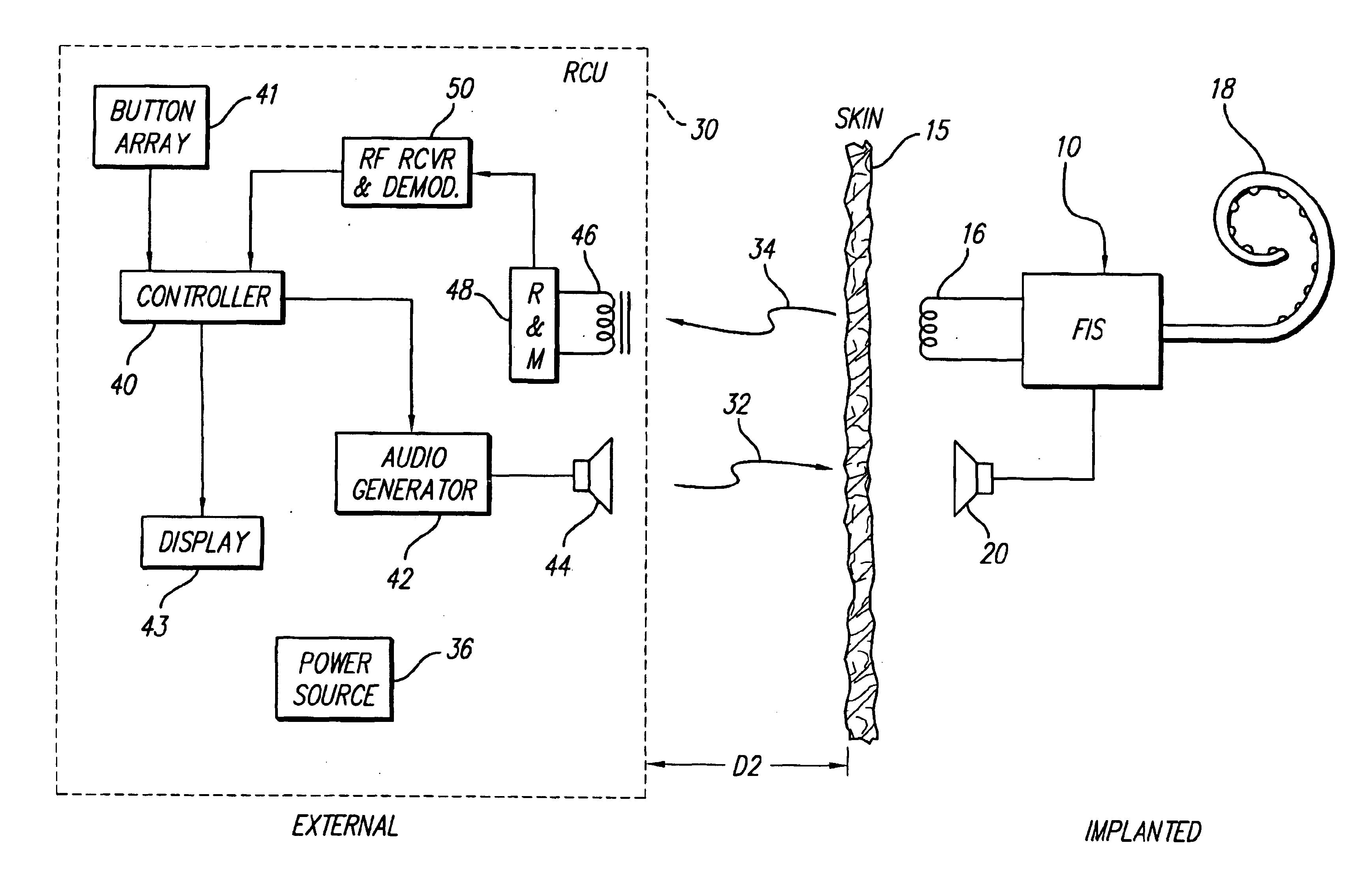 Implantable neural stimulator system including remote control unit for use therewith