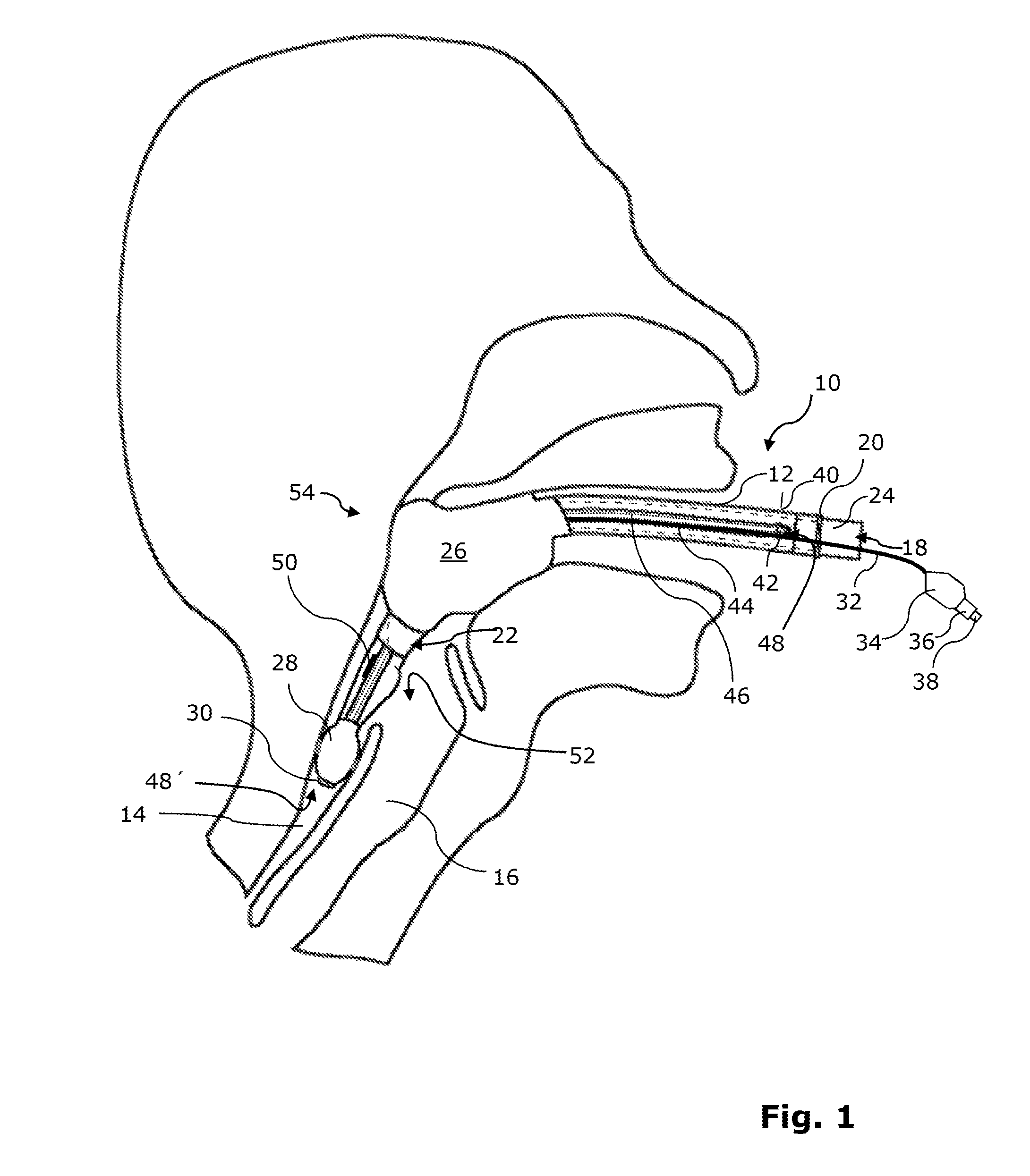 Larynx tube and method for the production thereof