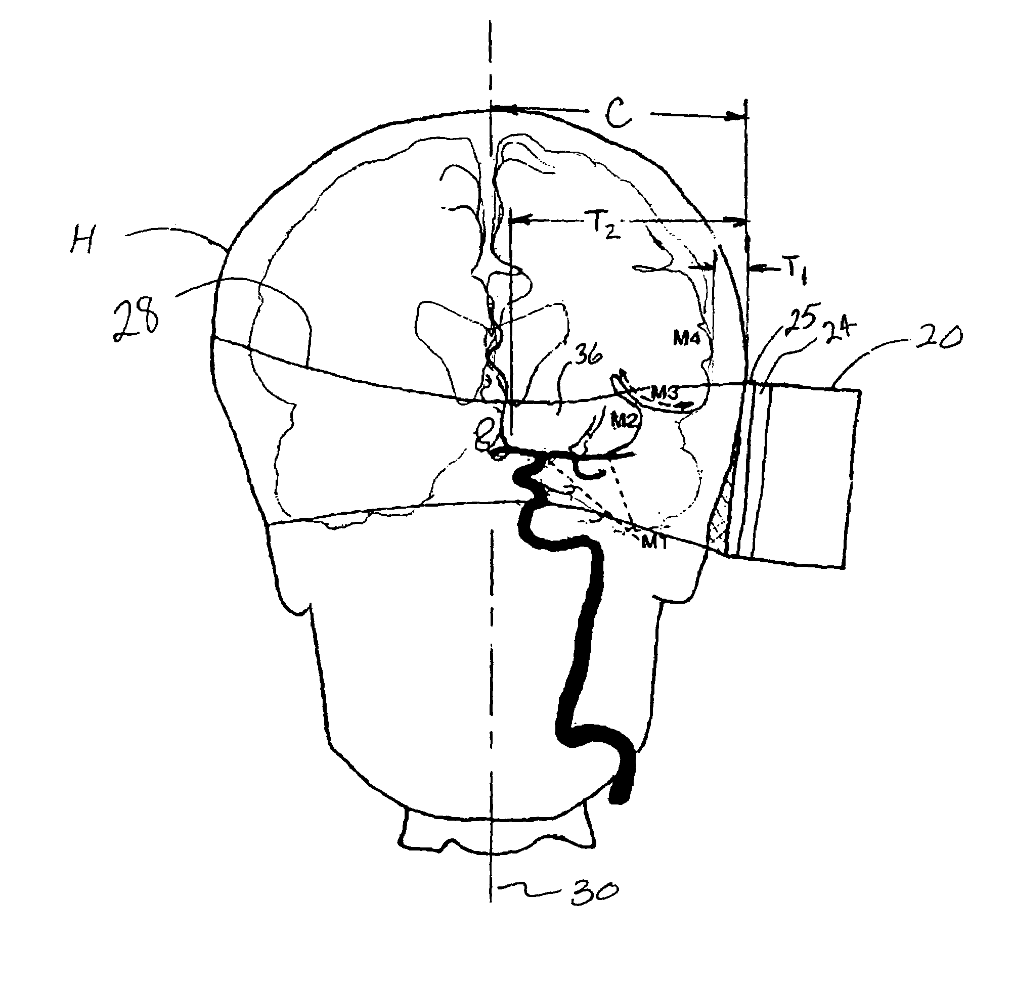 Transcranial ultrasound thrombolysis system and method of treating a stroke