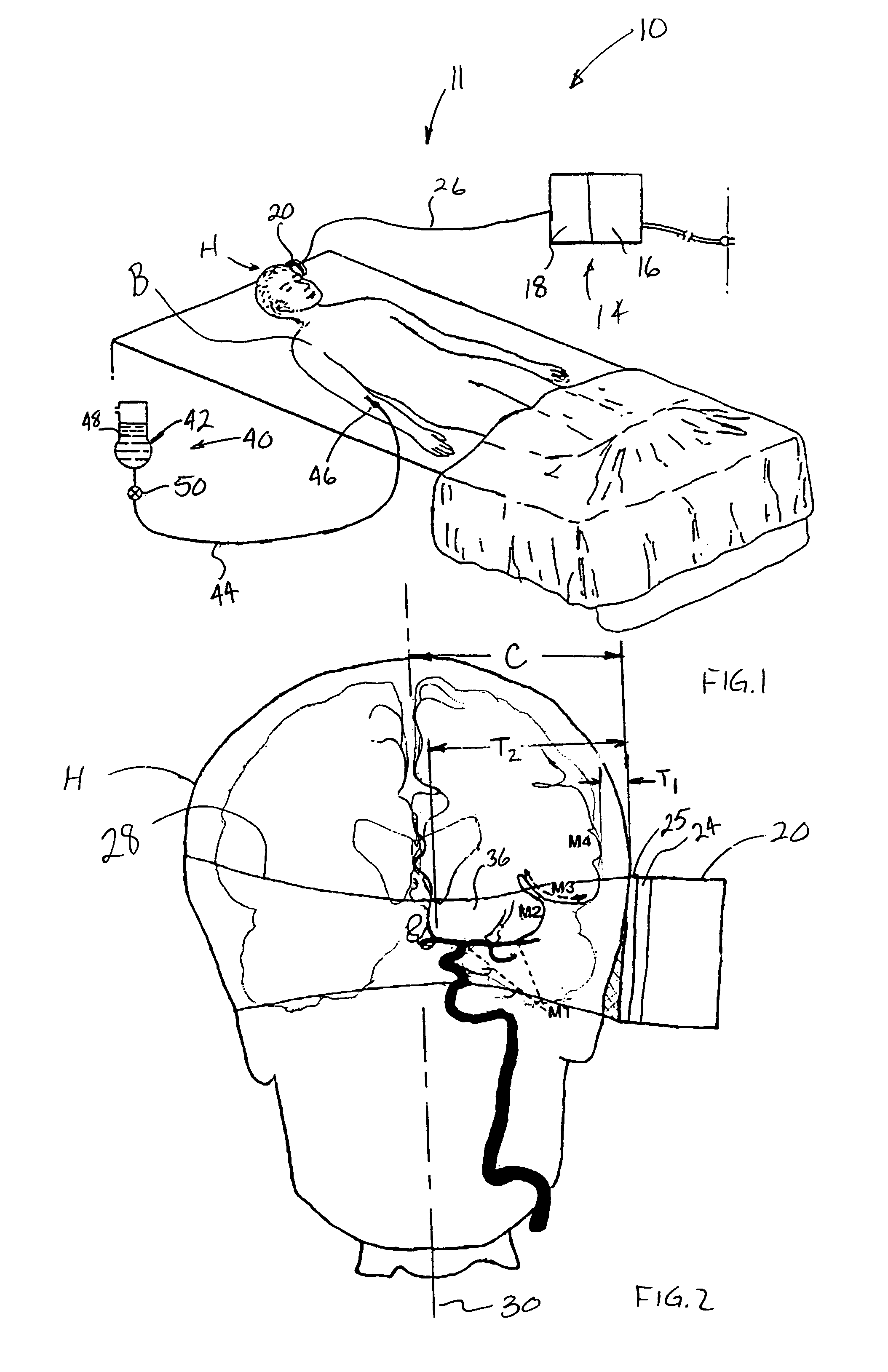 Transcranial ultrasound thrombolysis system and method of treating a stroke