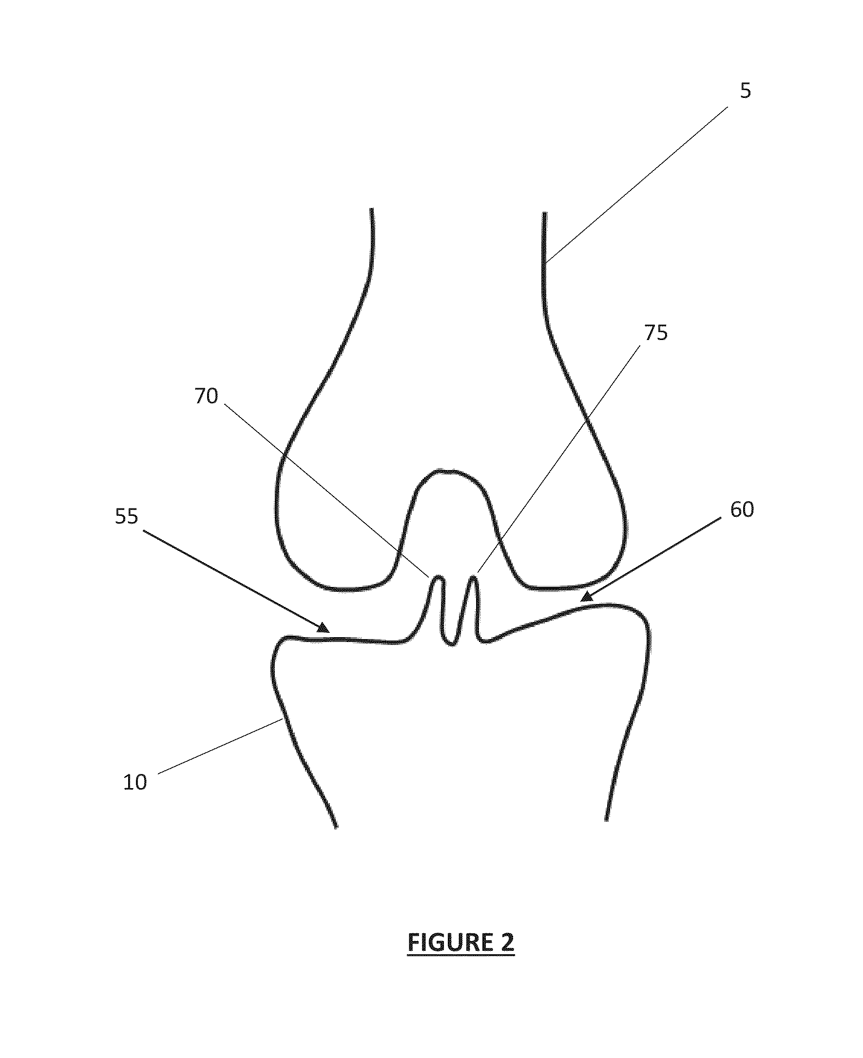Total Knee Arthroplasty System and Method