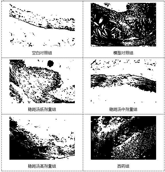Drug for preventing and treating atherosclerotic plaque by adopting methods for removing wind, expelling phlegm and detoxifying, and preparation method of drug